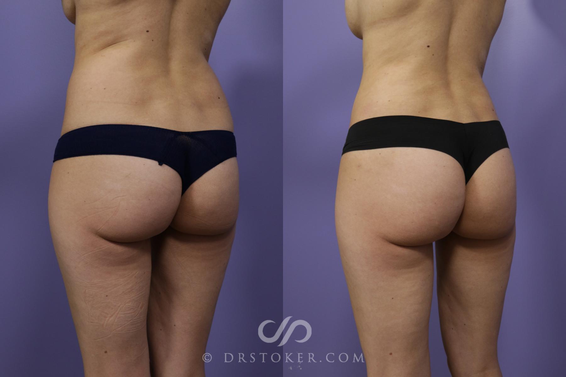 Before & After Liposuction Case 1370 View #3 View in Los Angeles, CA