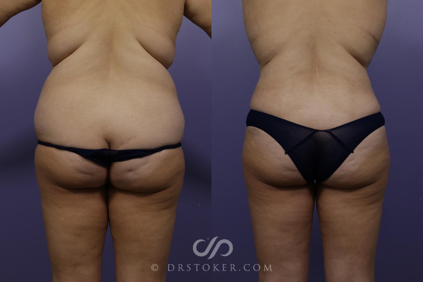 Before & After Liposuction Case 1460 View #1 View in Los Angeles, CA
