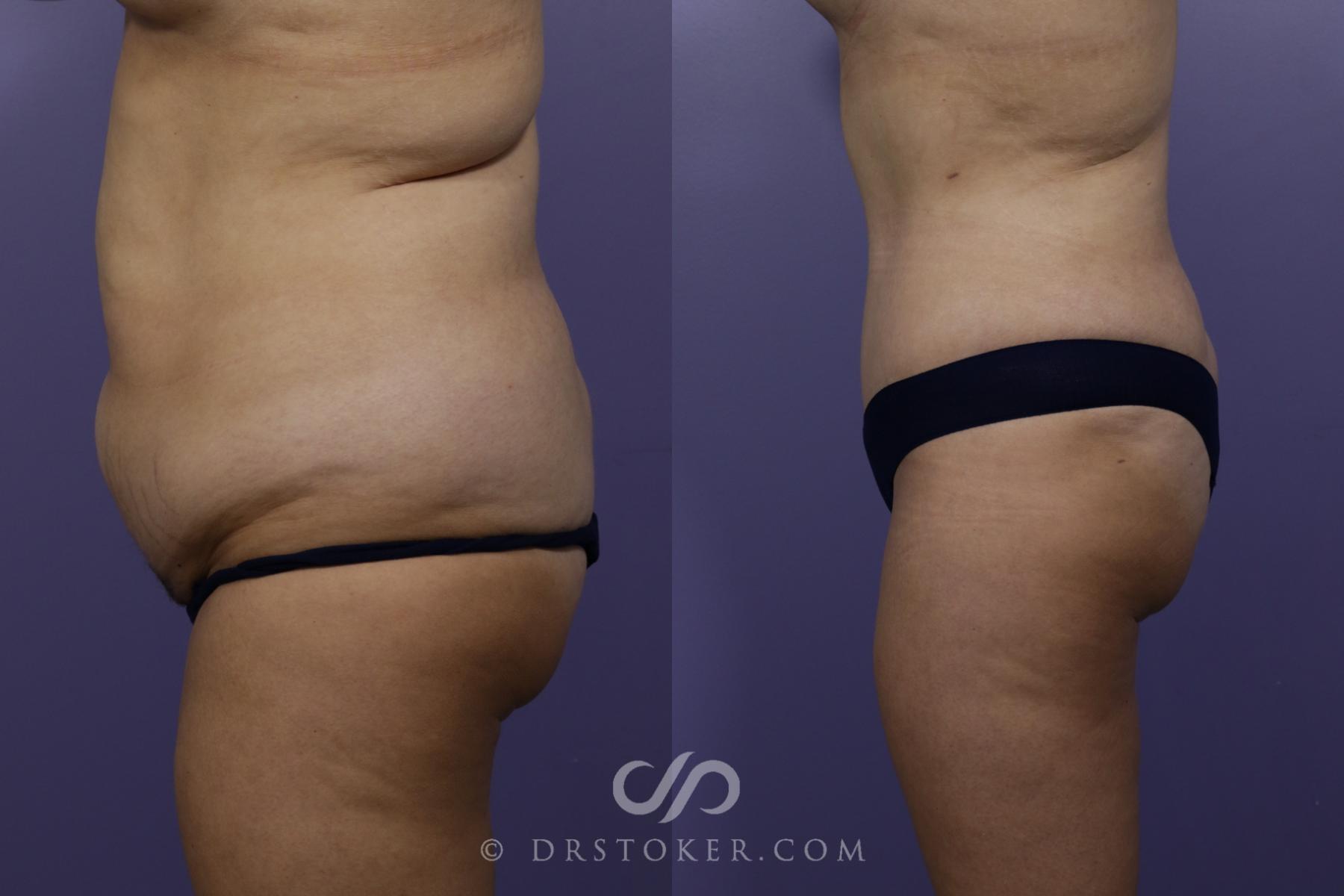 Before & After Liposuction Case 1460 View #2 View in Los Angeles, CA