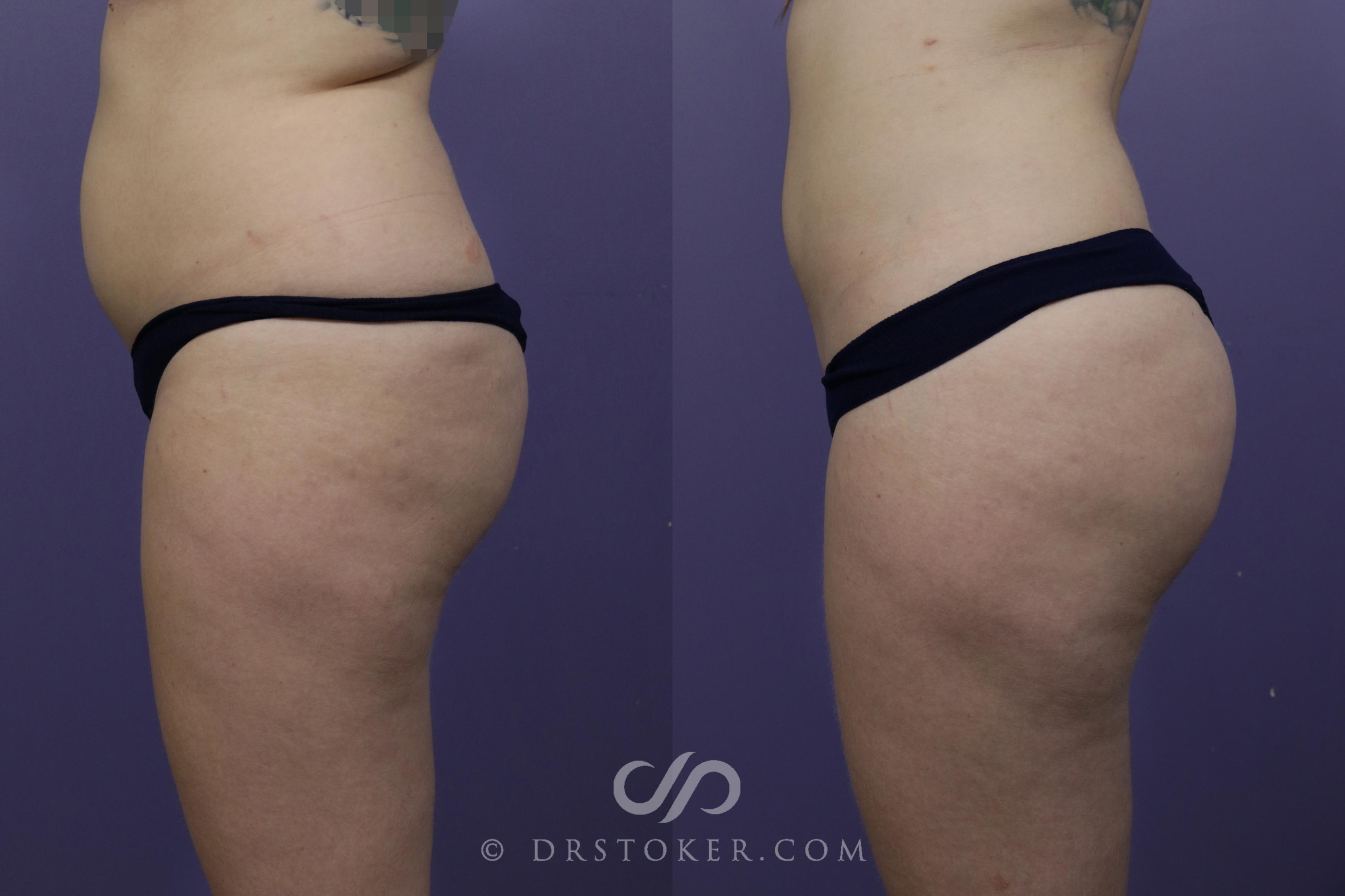 Before & After Brazilian Butt Lift (Fat Grafts to Buttocks) Case 1510 View #1 View in Los Angeles, CA