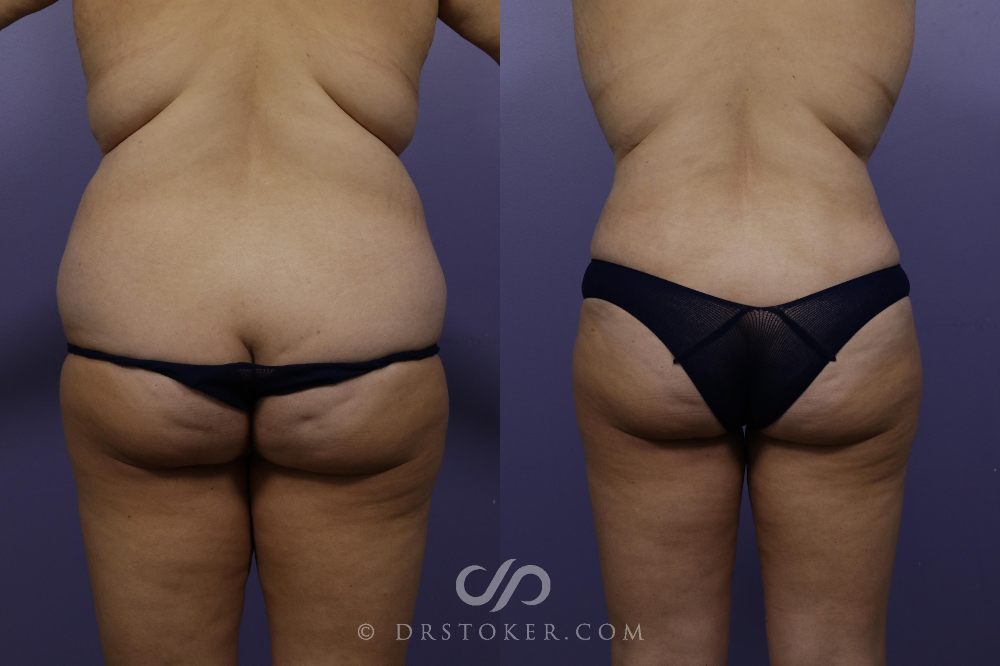 Before & After Liposuction Case 1536 View #1 View in Los Angeles, CA