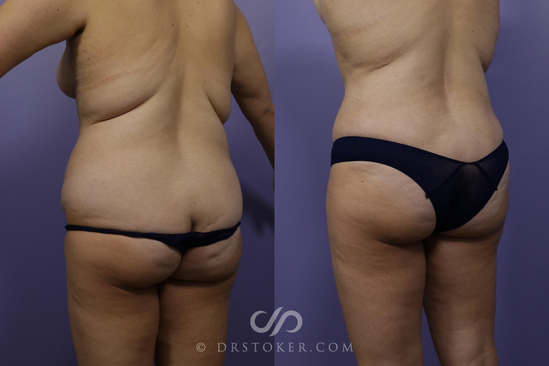 Before & After Liposuction Case 1536 View #2 View in Los Angeles, CA