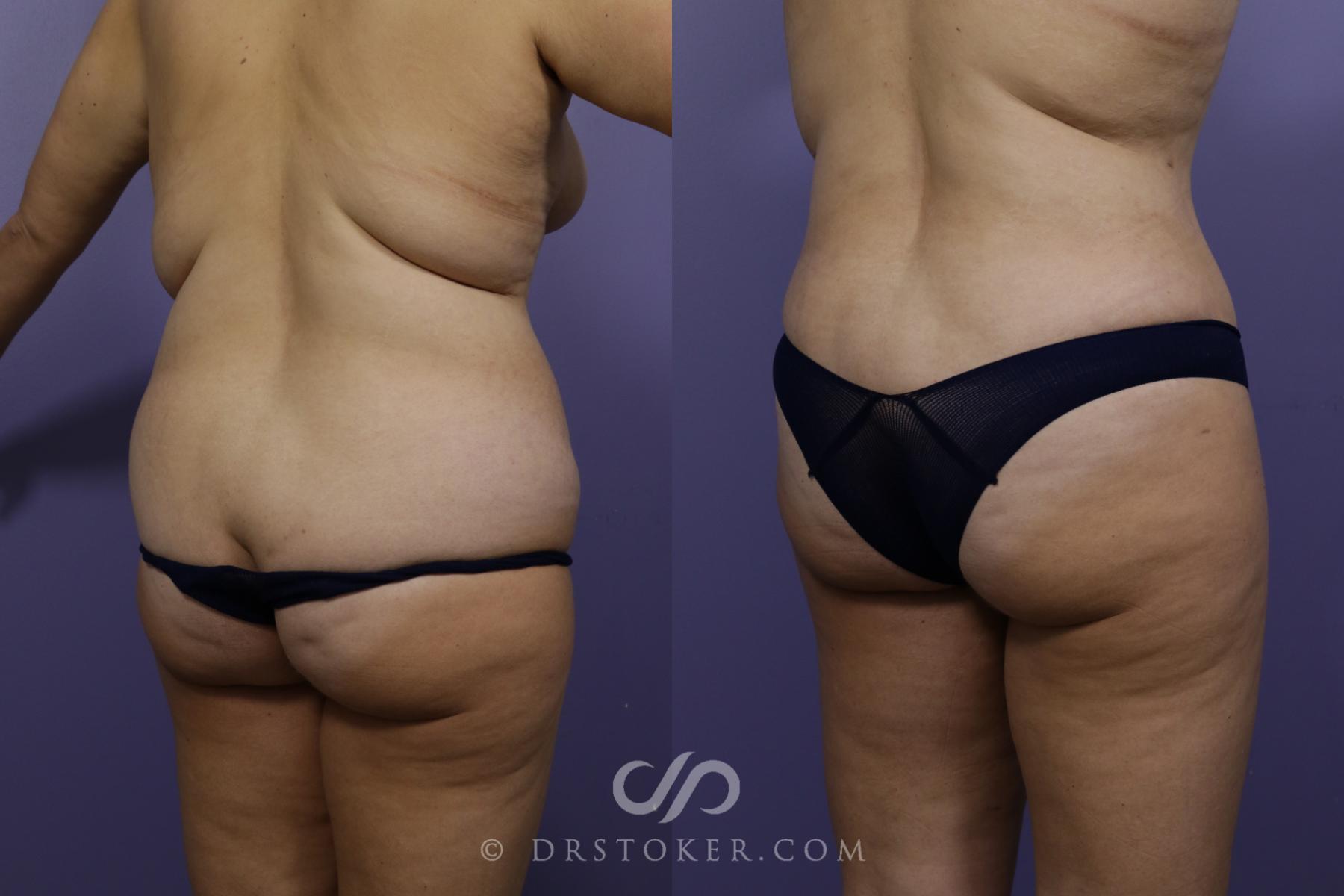 Before & After Liposuction Case 1536 View #3 View in Los Angeles, CA