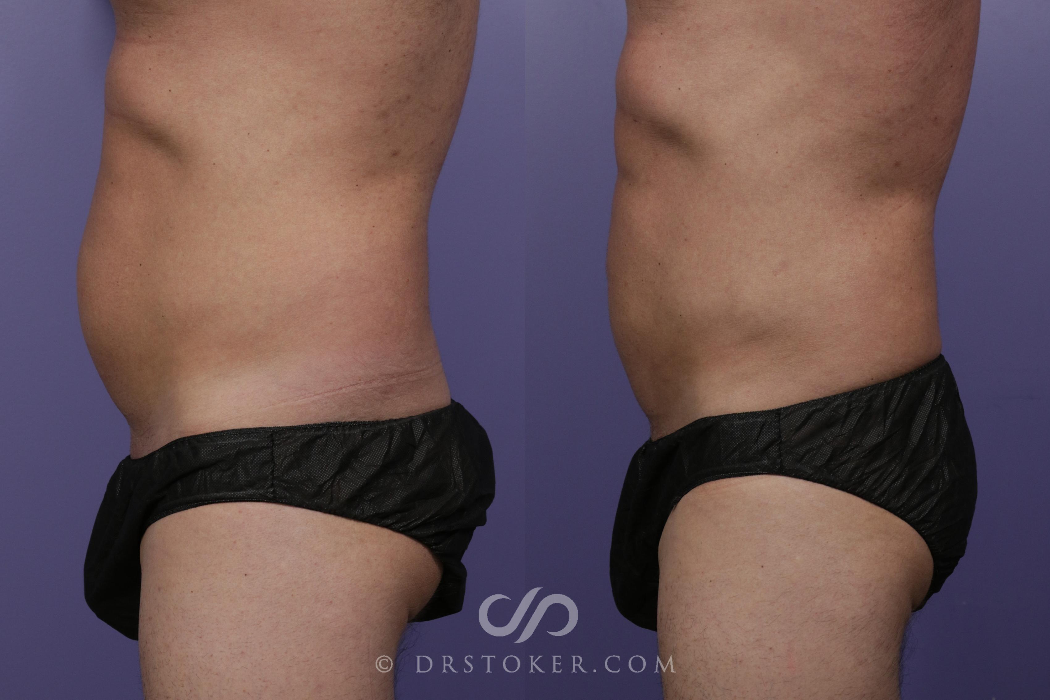 Before & After Abdominal Etching & Sculpting for Men Case 1538 View #1 View in Marina del Rey, CA