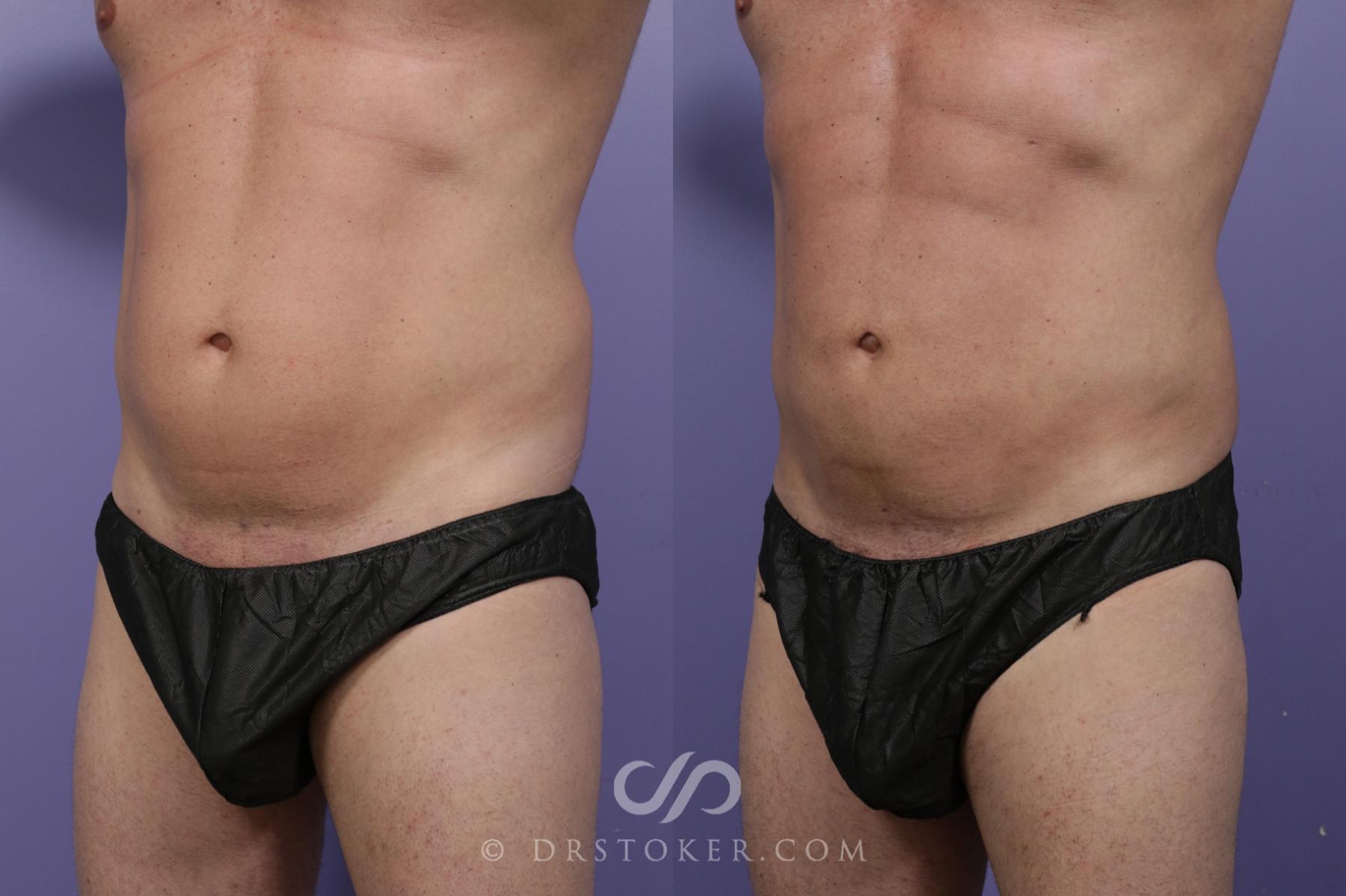 Before & After Liposuction Case 1538 View #2 View in Los Angeles, CA