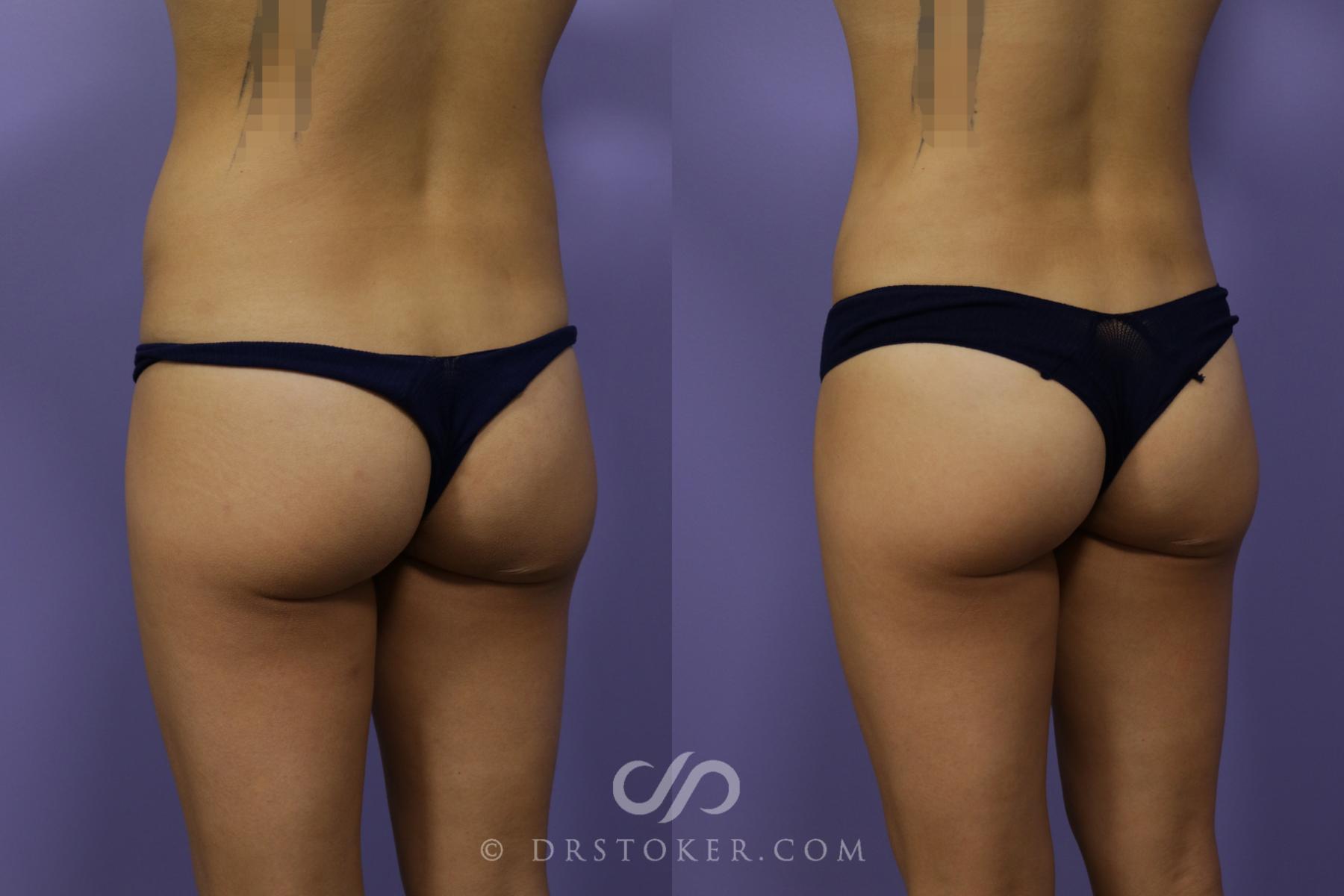 Before & After Liposuction Case 1541 View #2 View in Los Angeles, CA