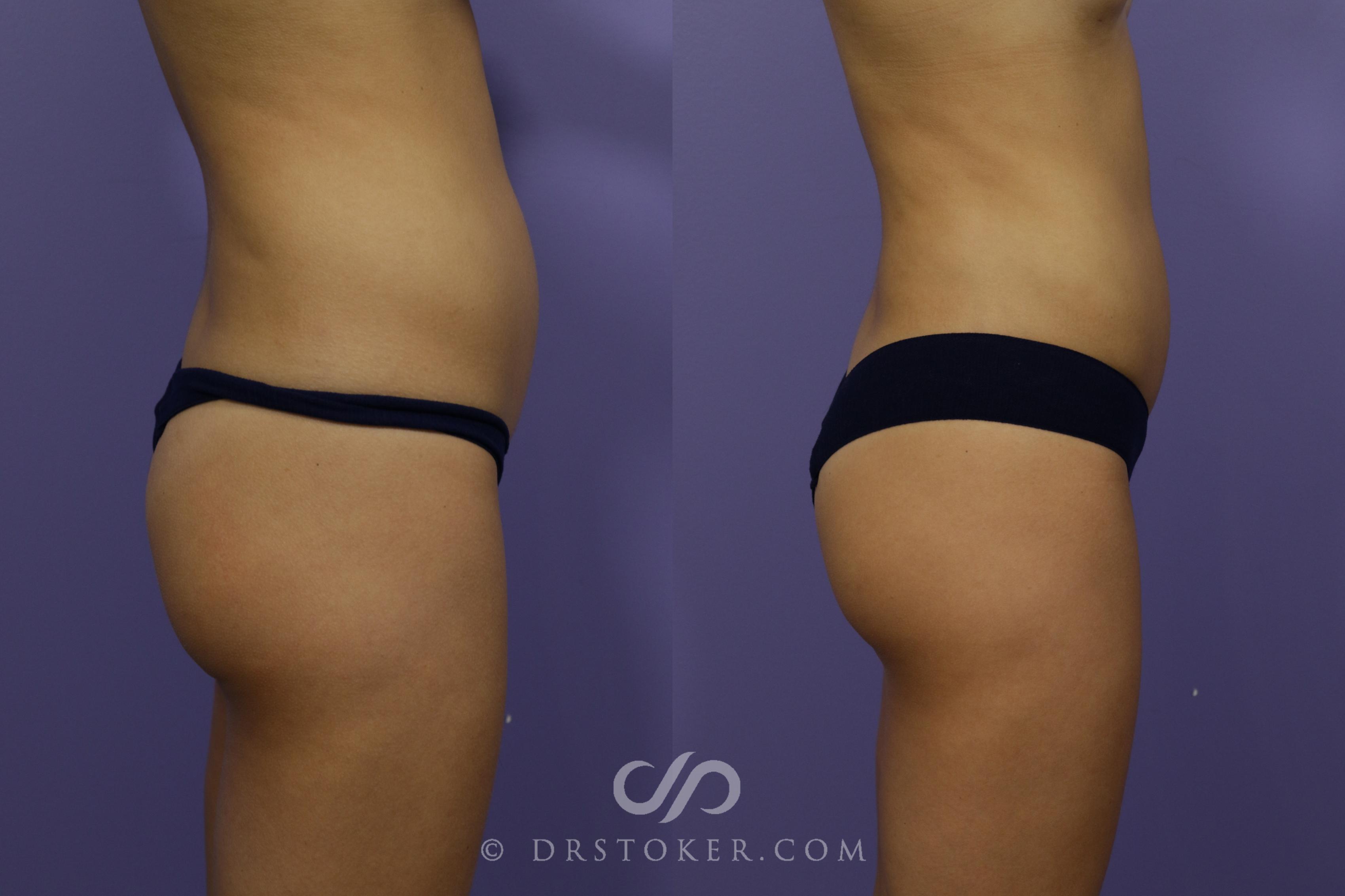 Before & After Liposuction Case 1541 View #3 View in Los Angeles, CA