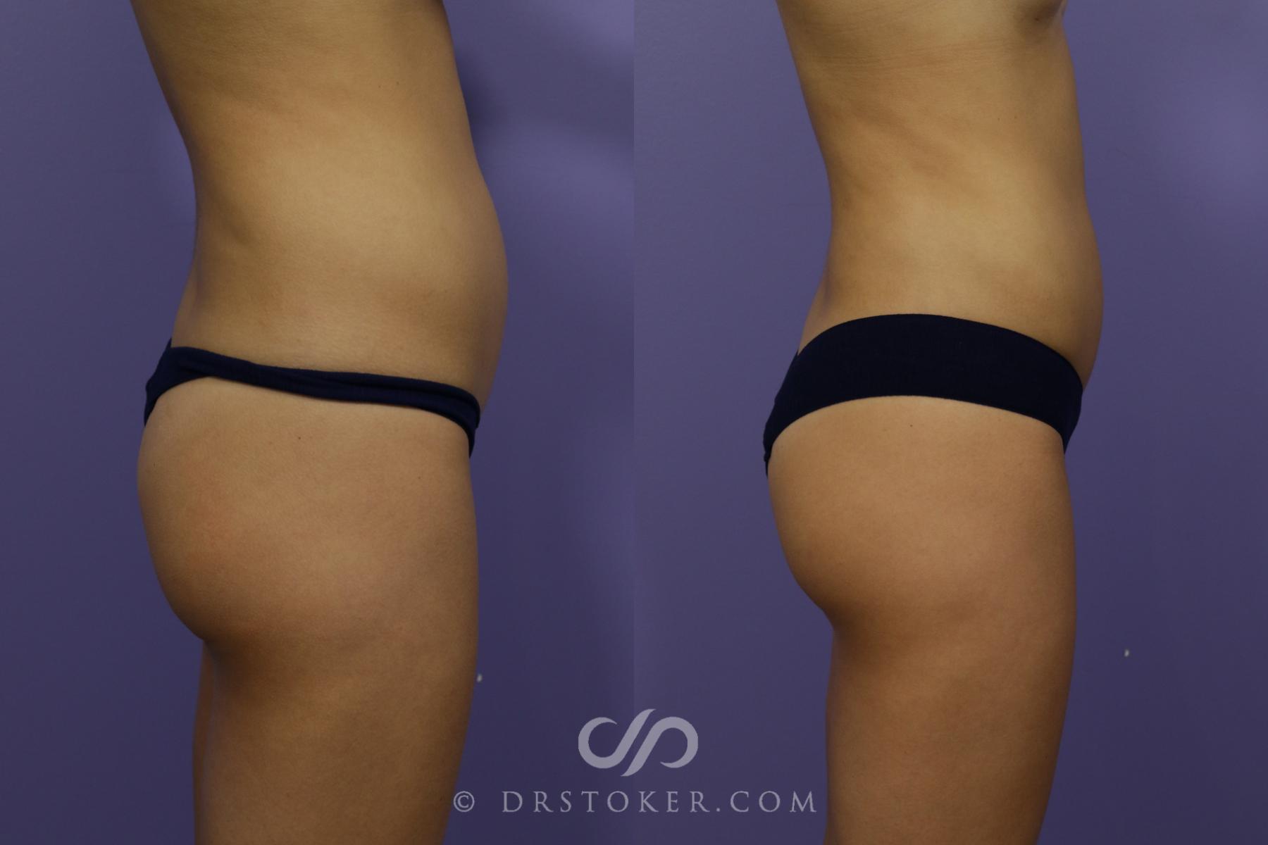 Before & After Liposuction Case 1541 View #3 View in Los Angeles, CA