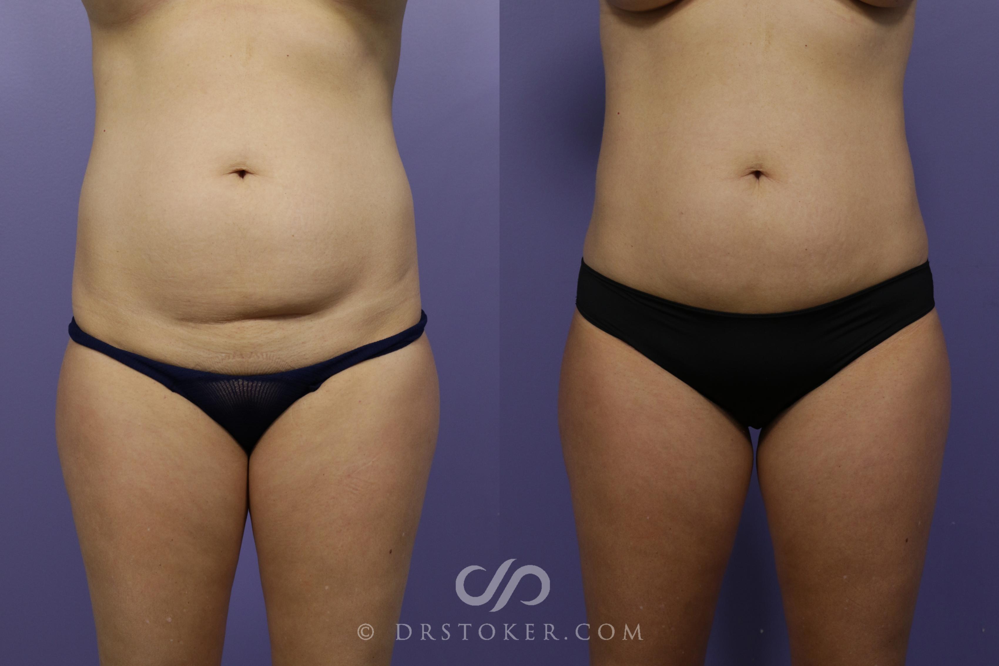 Before & After Liposuction Case 1542 View #1 View in Los Angeles, CA