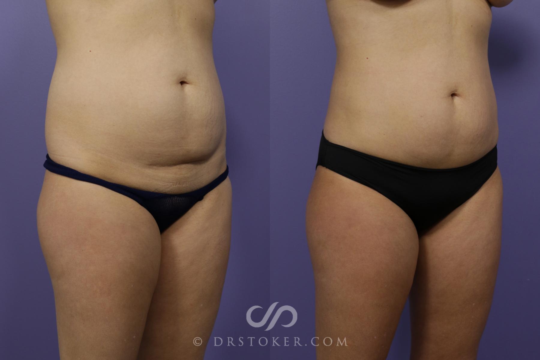 Before & After Liposuction Case 1542 View #2 View in Los Angeles, CA
