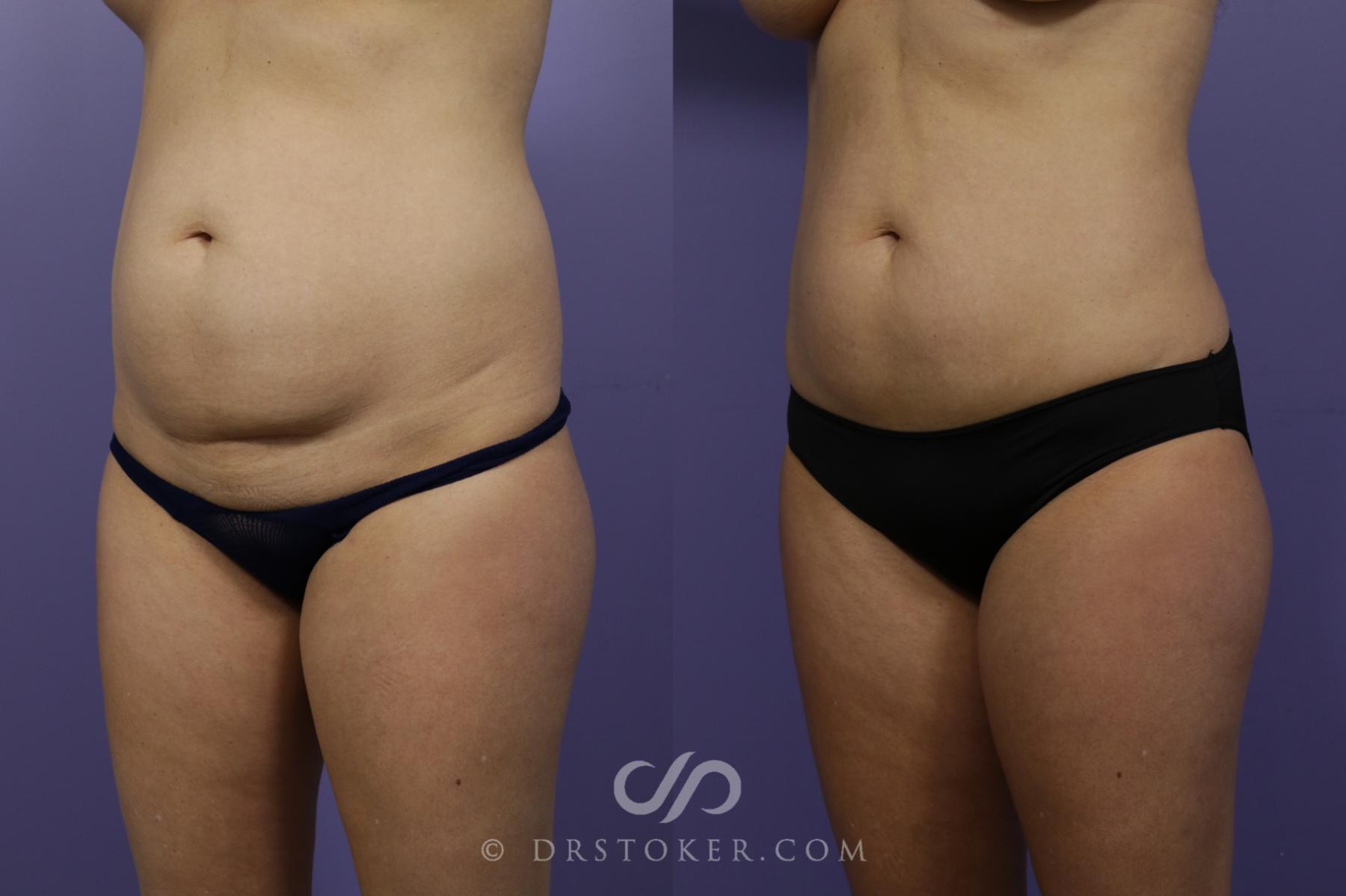 Before & After Liposuction Case 1542 View #3 View in Los Angeles, CA