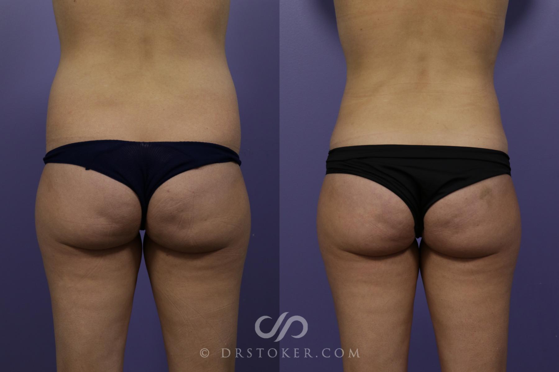 Before & After Liposuction Case 1543 View #1 View in Los Angeles, CA