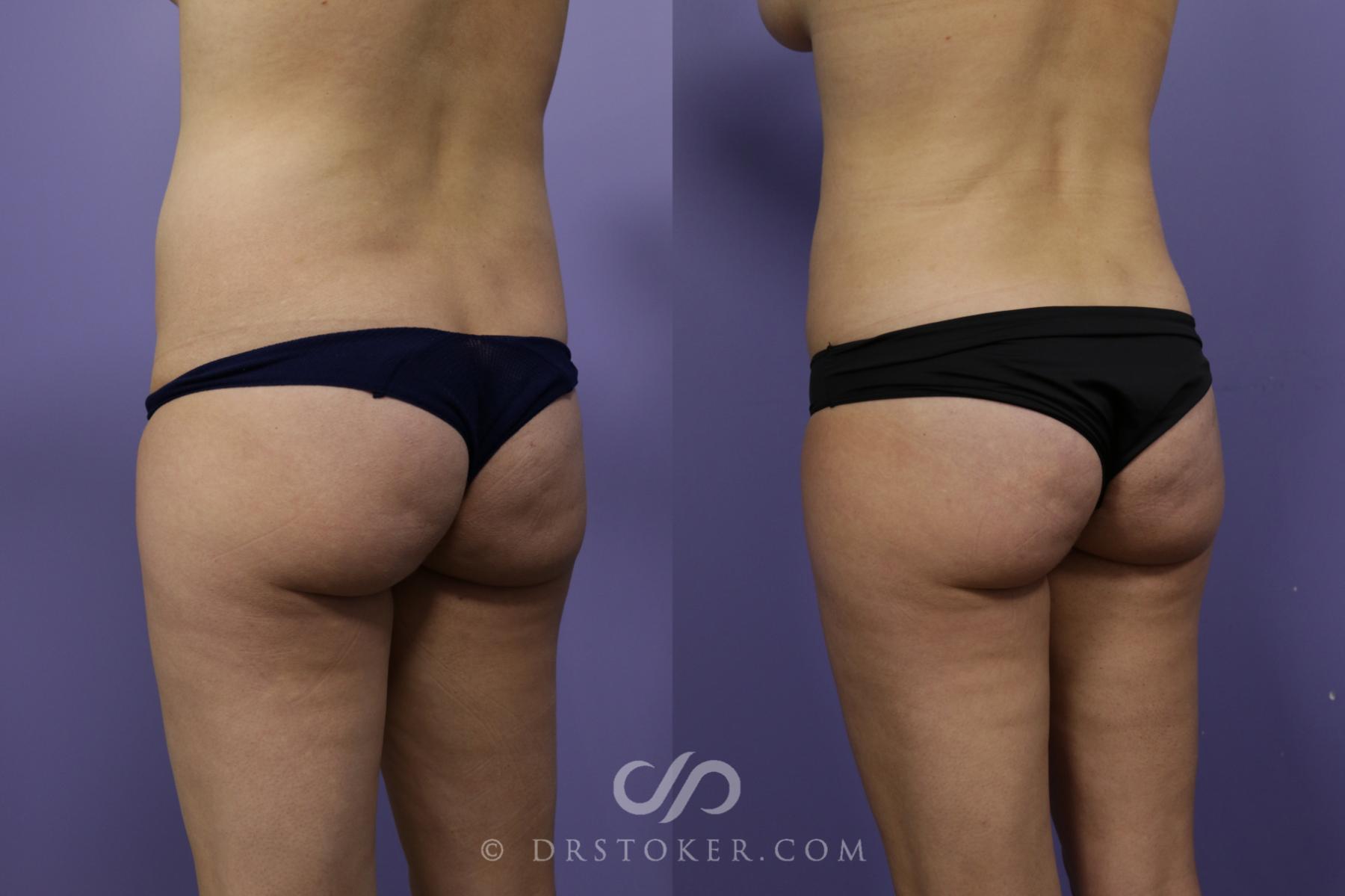 Before & After Liposuction Case 1543 View #2 View in Los Angeles, CA