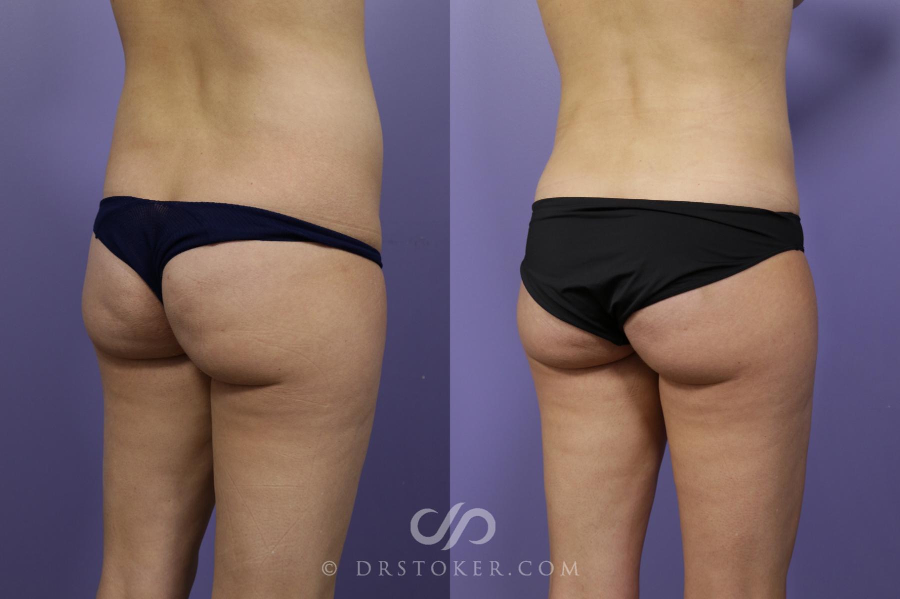 Before & After Liposuction Case 1543 View #3 View in Los Angeles, CA