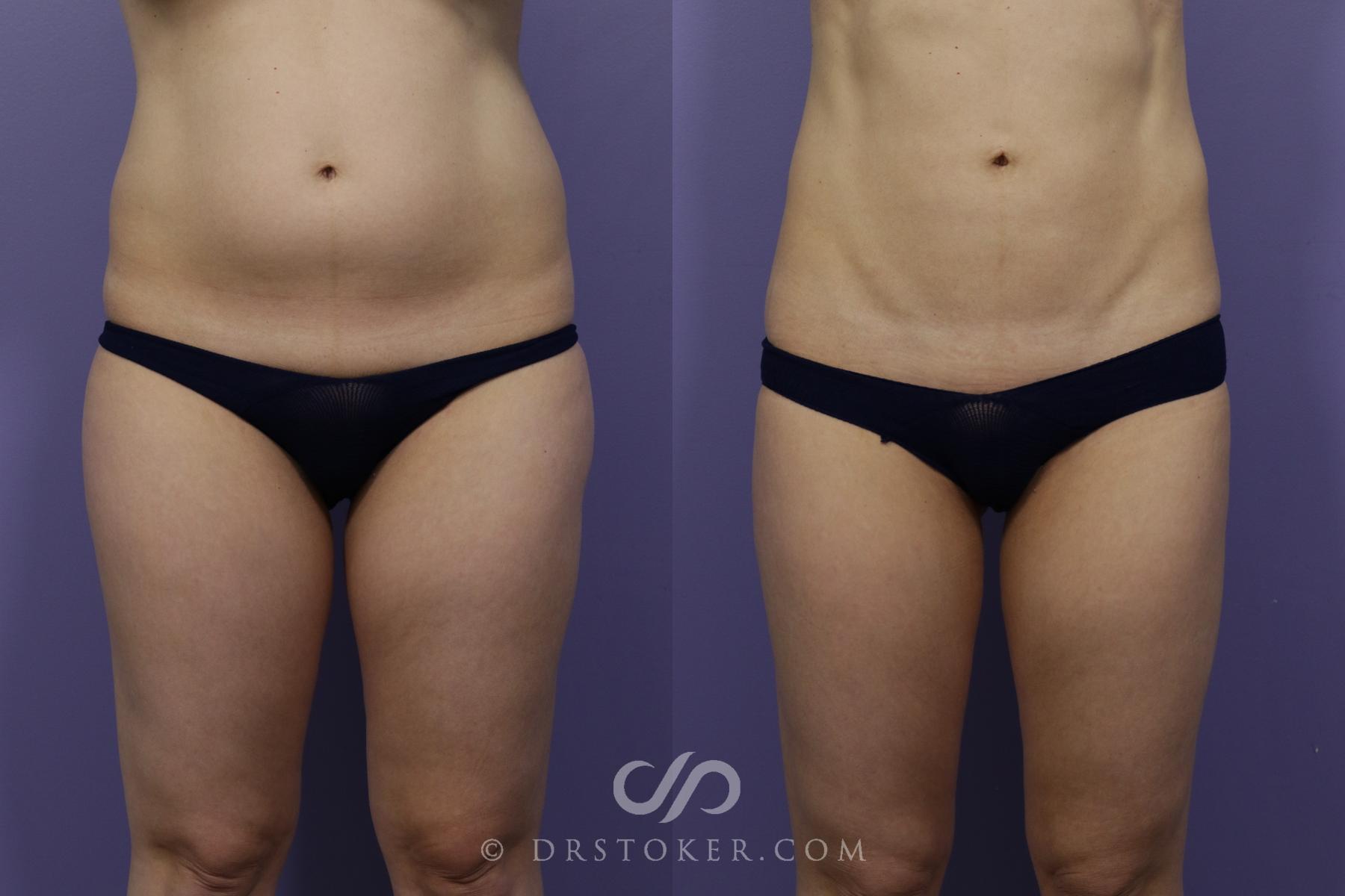 Before & After Liposuction - Abdominal Etching & Sculpting Case 1544 View #1 View in Los Angeles, CA