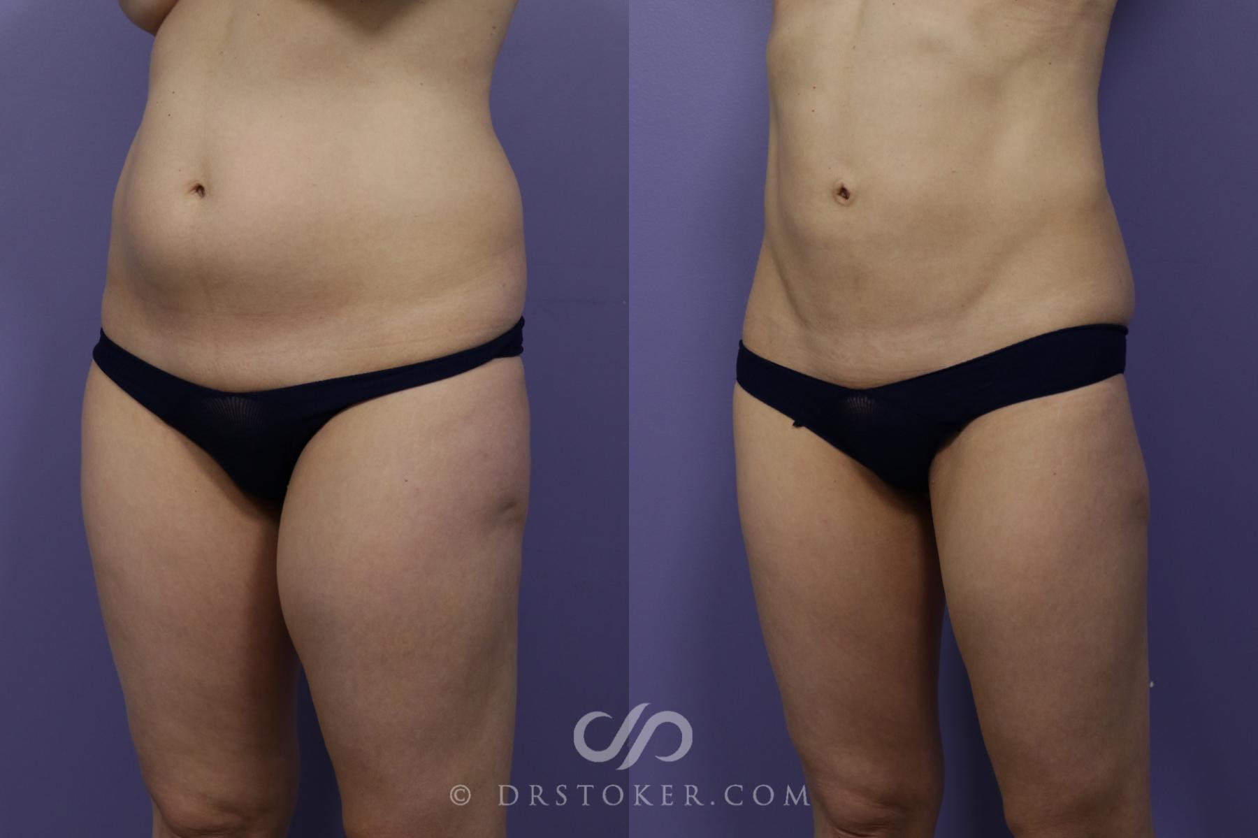 Before & After Liposuction Case 1544 View #2 View in Los Angeles, CA