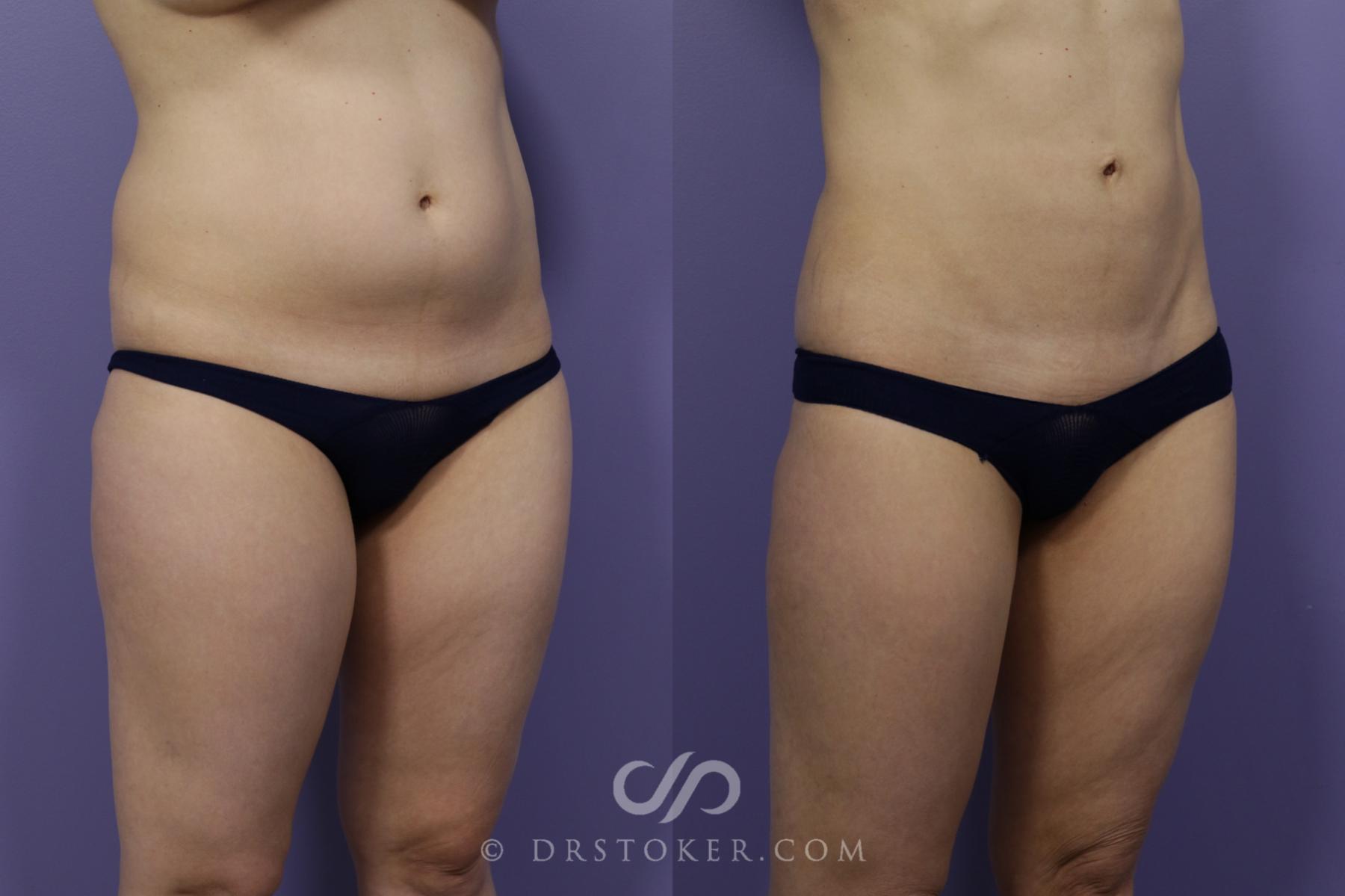 Before & After Liposuction Case 1544 View #3 View in Los Angeles, CA