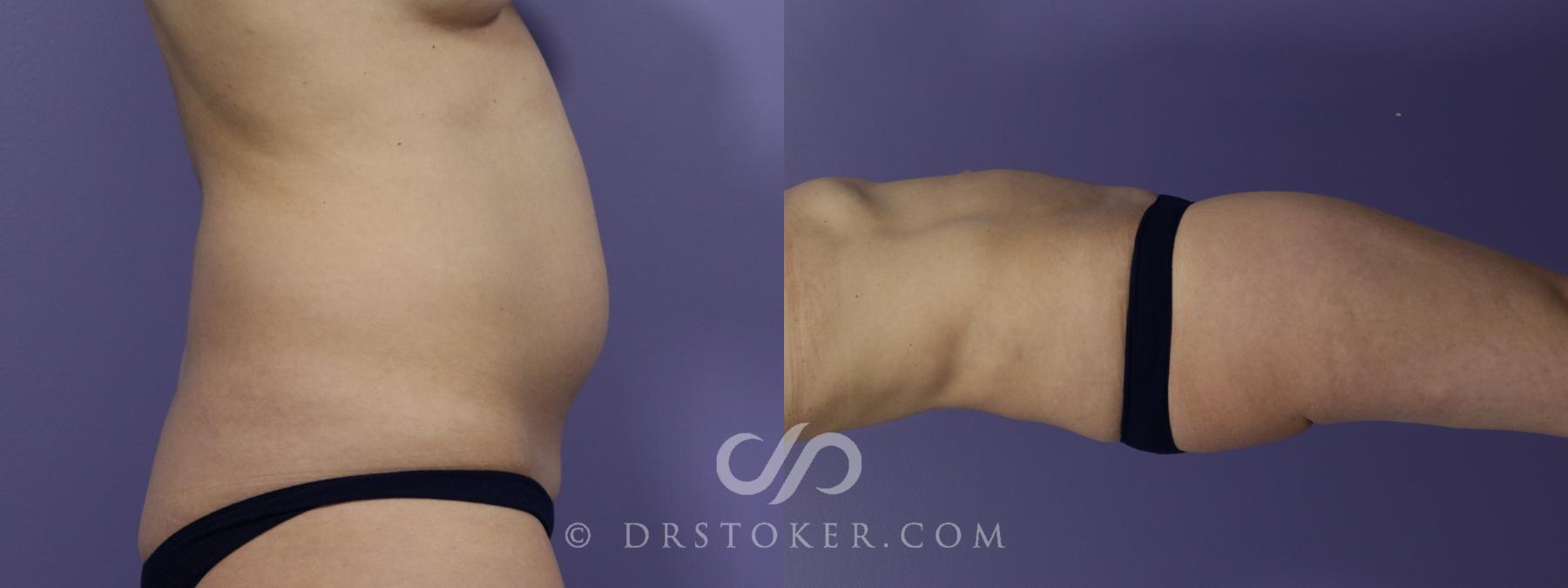 Before & After Liposuction - Abdominal Etching & Sculpting Case 1544 View #4 View in Los Angeles, CA