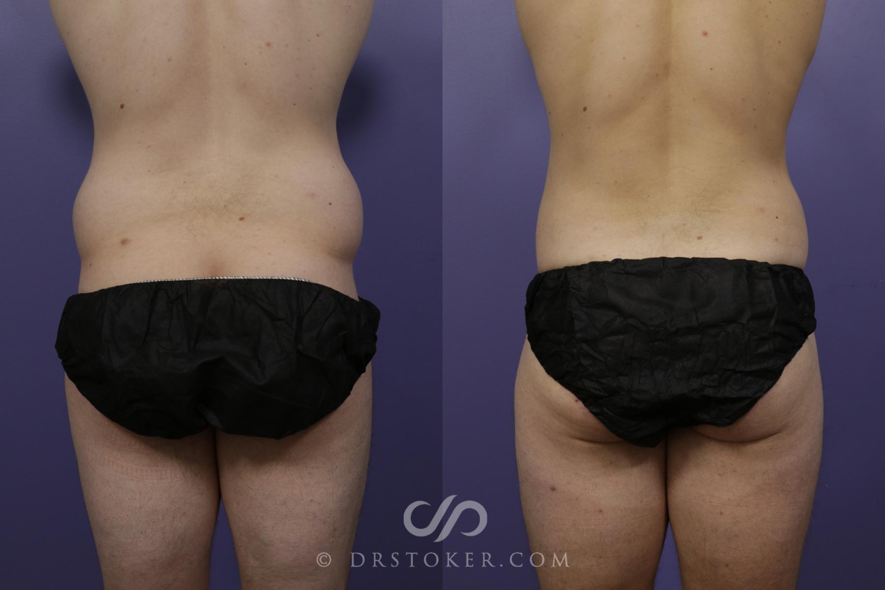 Before & After Liposuction Case 1548 View #1 View in Los Angeles, CA