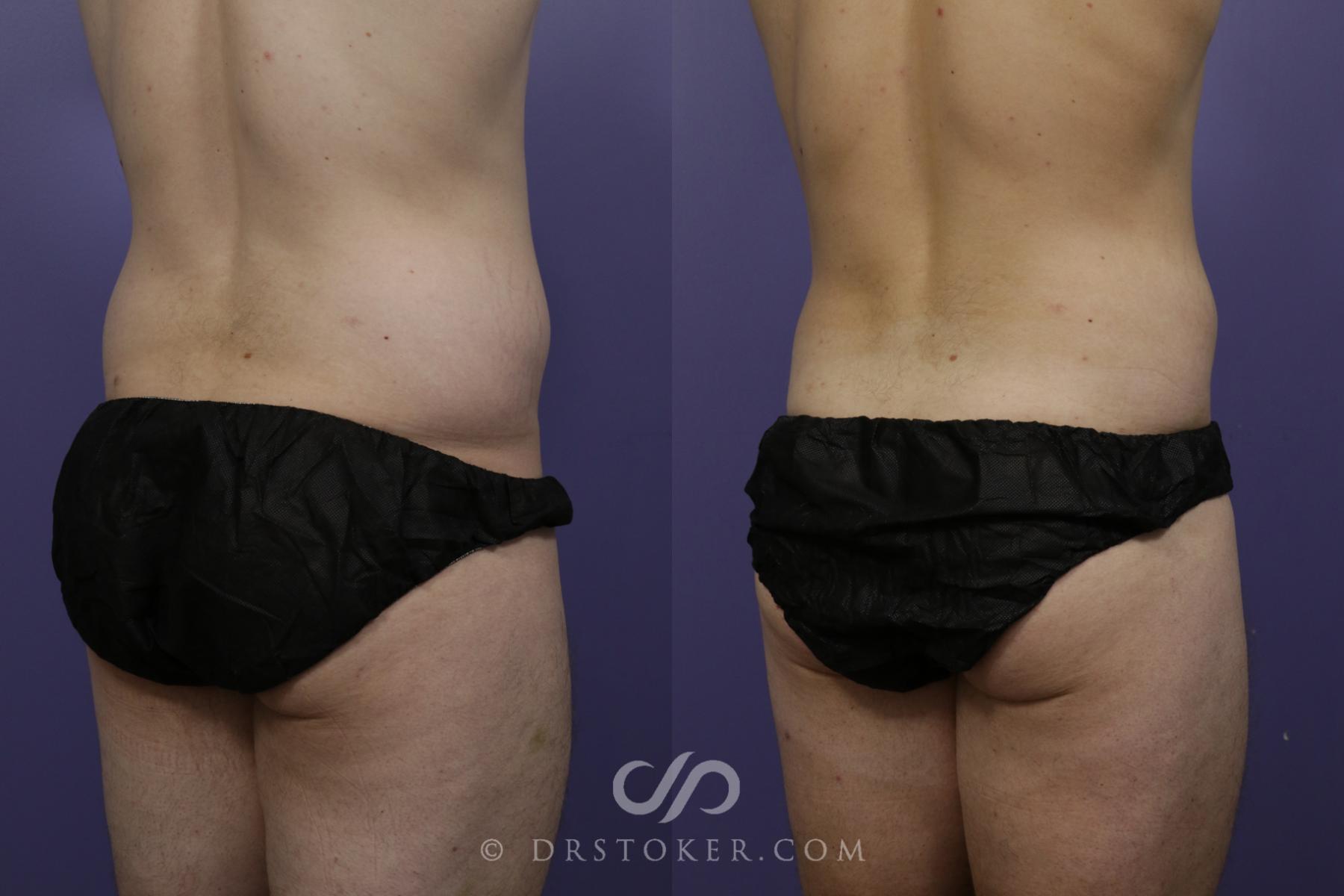 Before & After Liposuction Case 1548 View #2 View in Los Angeles, CA