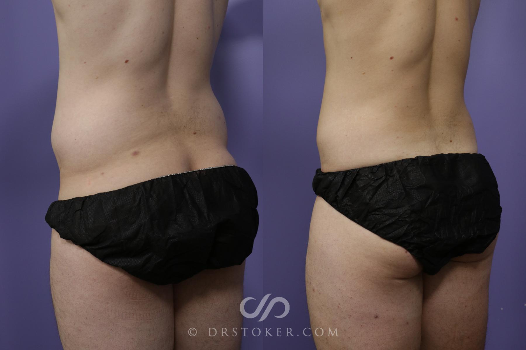 Before & After Liposuction Case 1548 View #3 View in Los Angeles, CA