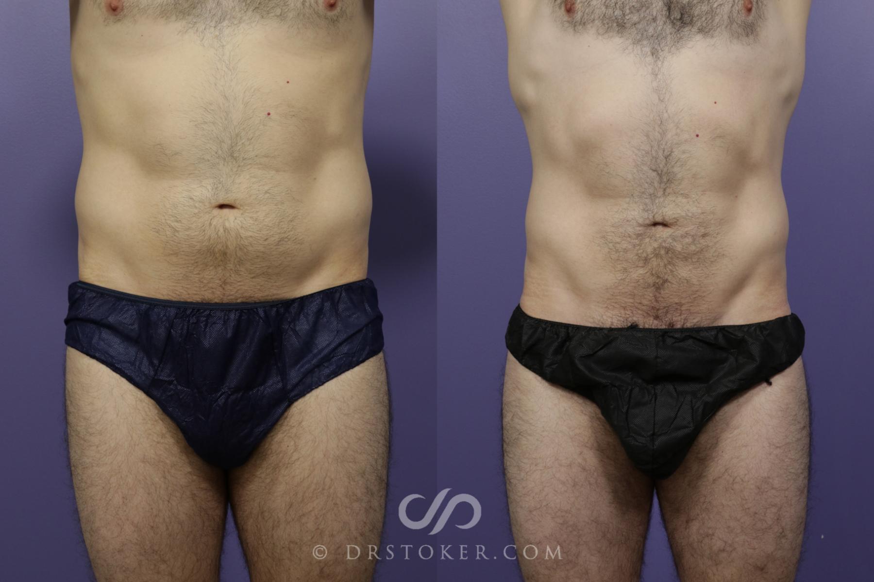Before & After Liposuction Case 1549 View #1 View in Los Angeles, CA