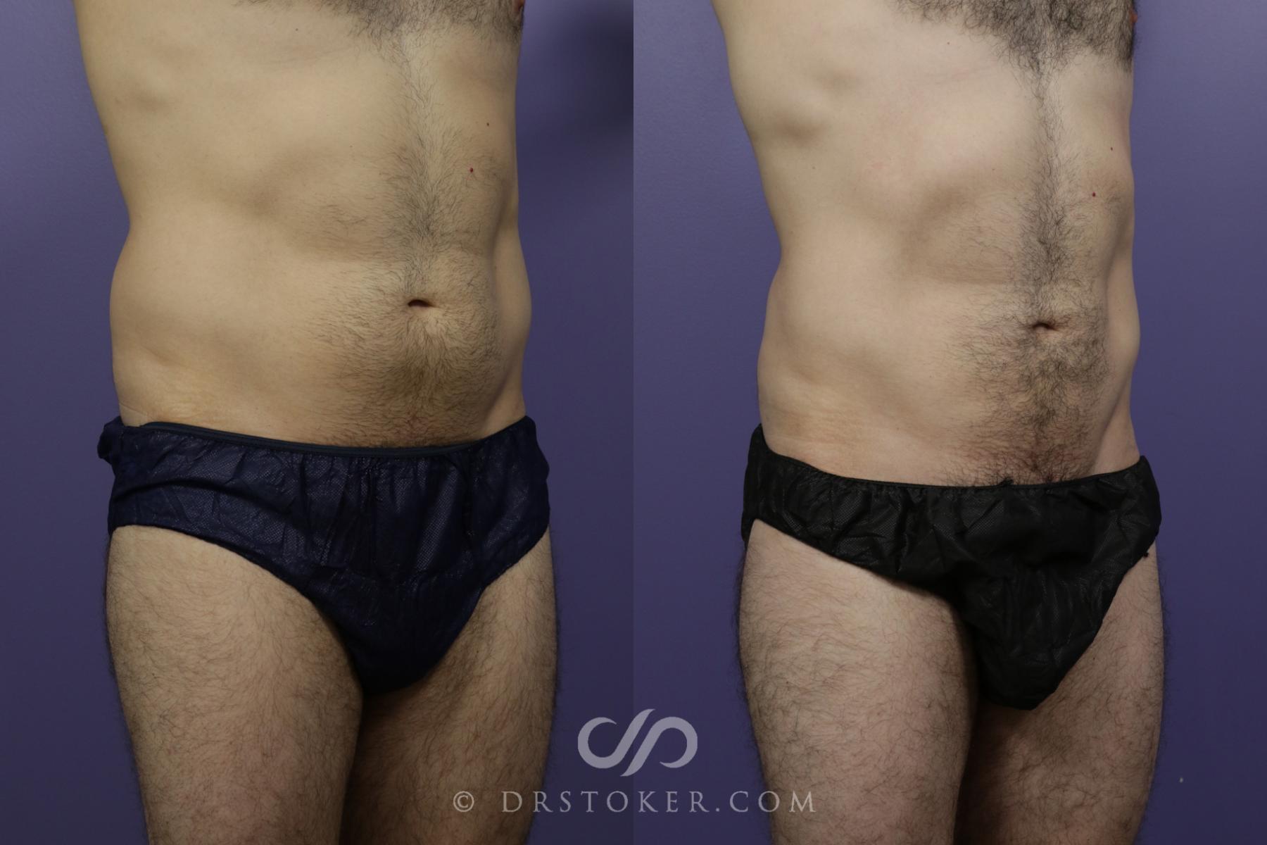 Before & After Liposuction Case 1549 View #2 View in Los Angeles, CA