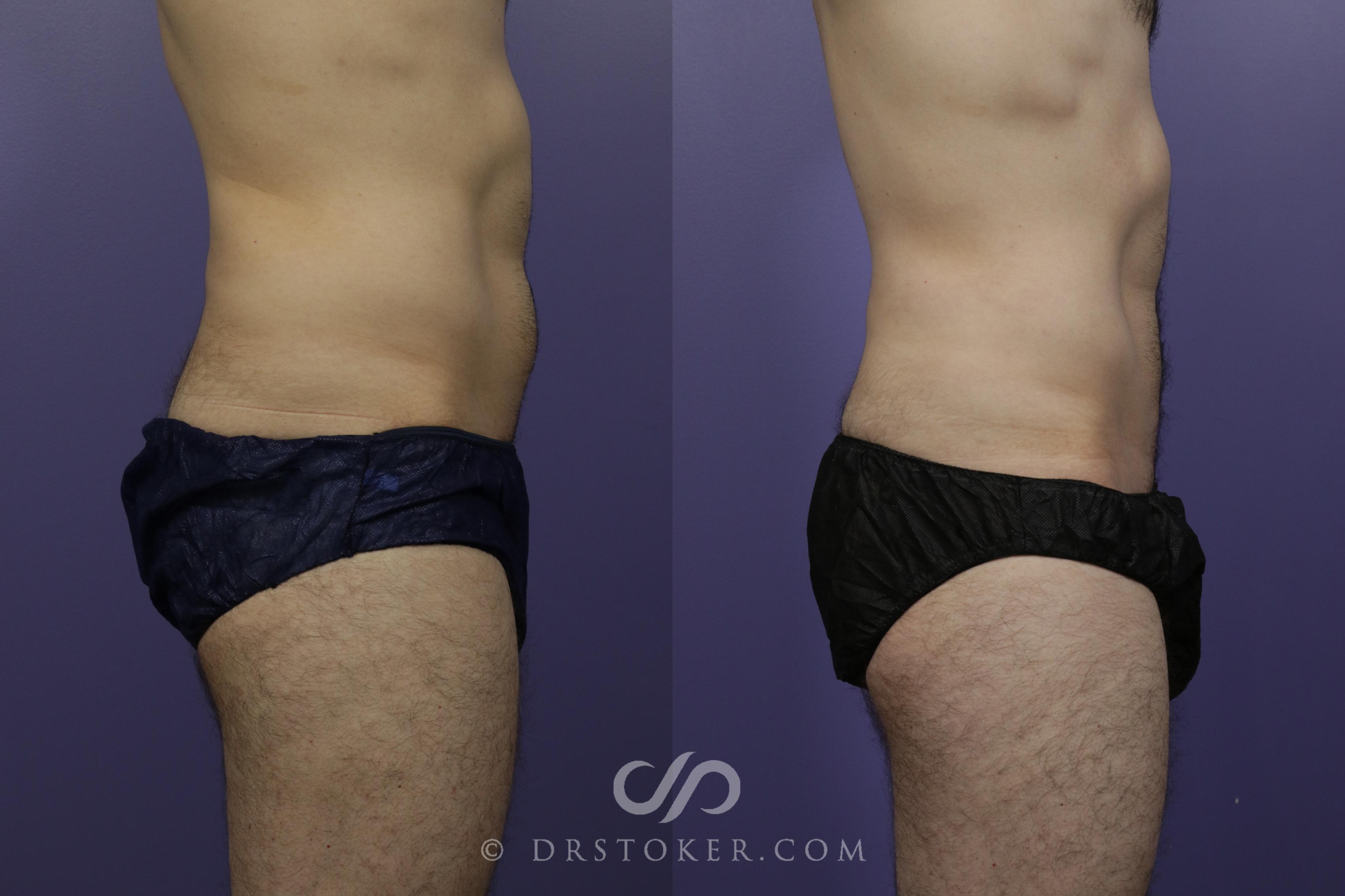 Before & After Liposuction Case 1549 View #3 View in Los Angeles, CA