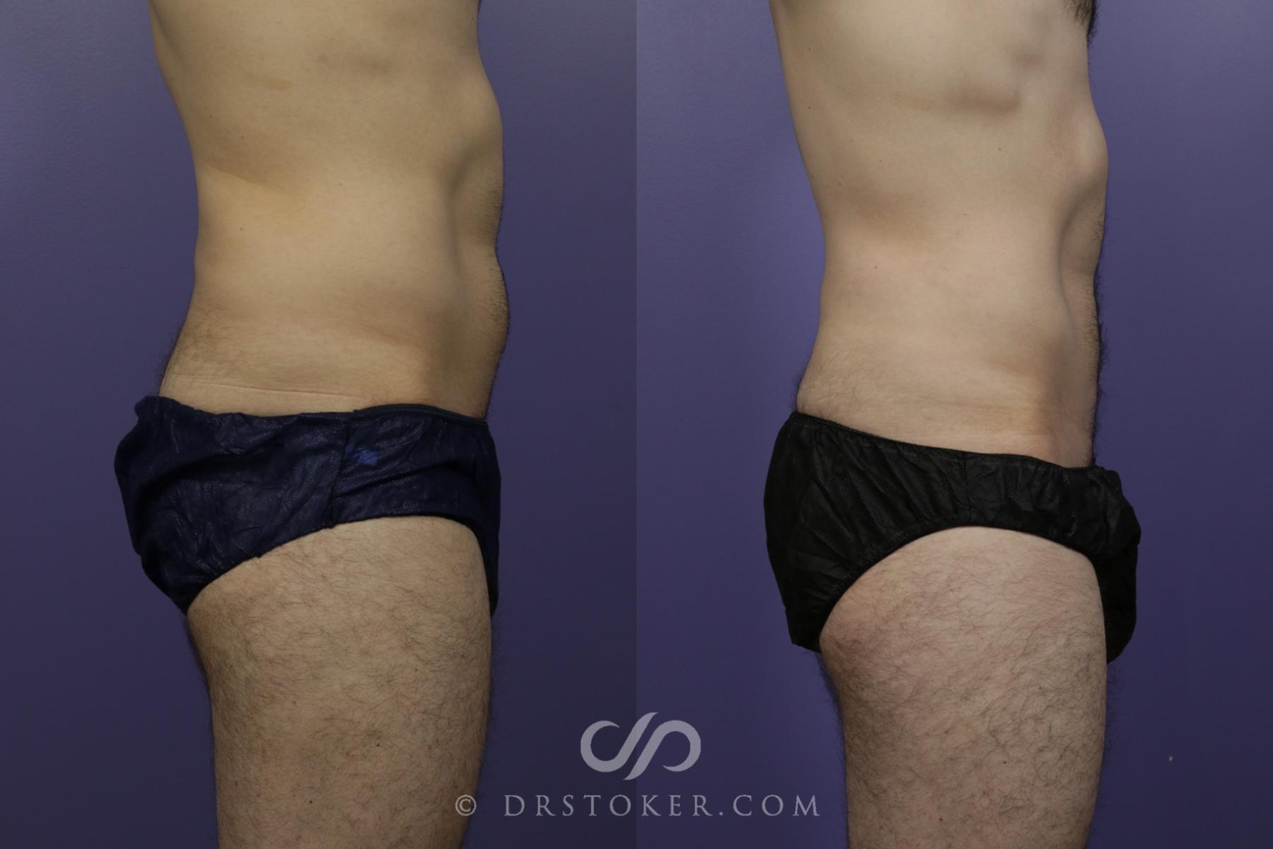 Before & After Liposuction Case 1549 View #3 View in Los Angeles, CA