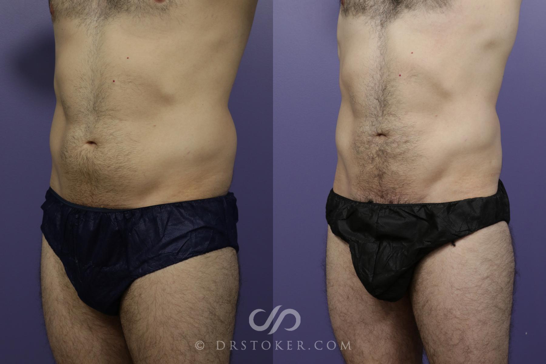Before & After Liposuction Case 1549 View #4 View in Los Angeles, CA