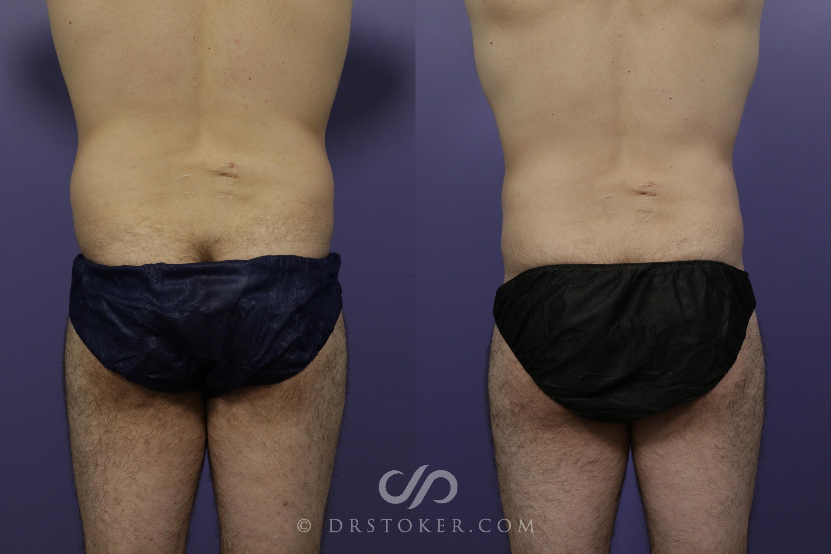 Before & After Liposuction for Men Case 1550 View #1 View in Los Angeles, CA