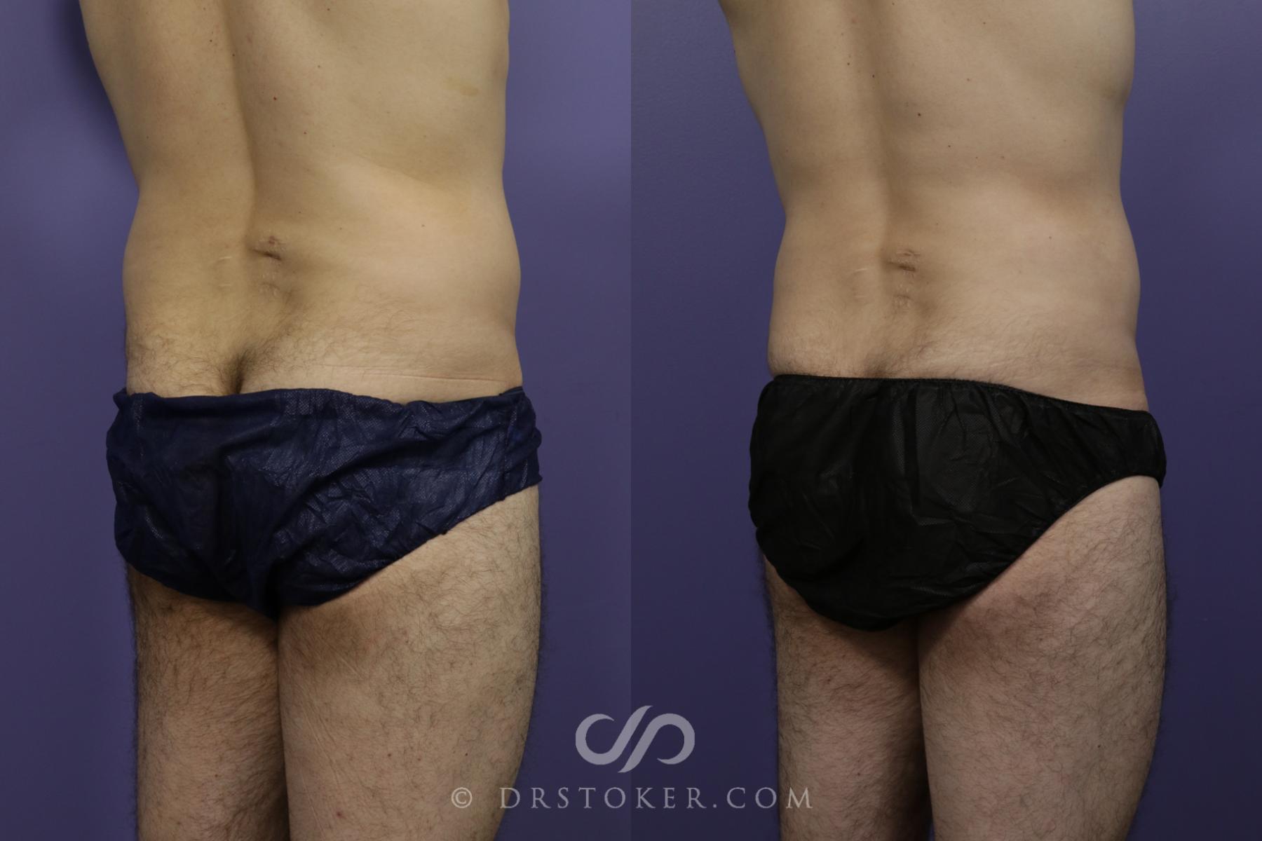 Before & After Liposuction Case 1550 View #2 View in Los Angeles, CA