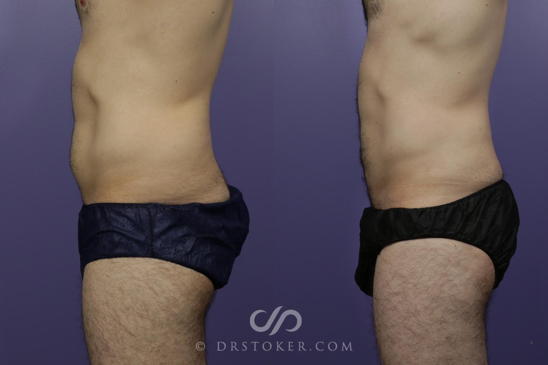 Before & After Liposuction for Men Case 1550 View #3 View in Los Angeles, CA