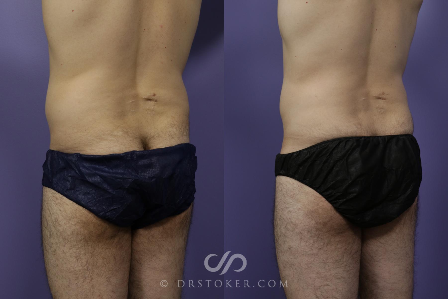Before & After Liposuction for Men Case 1550 View #4 View in Los Angeles, CA