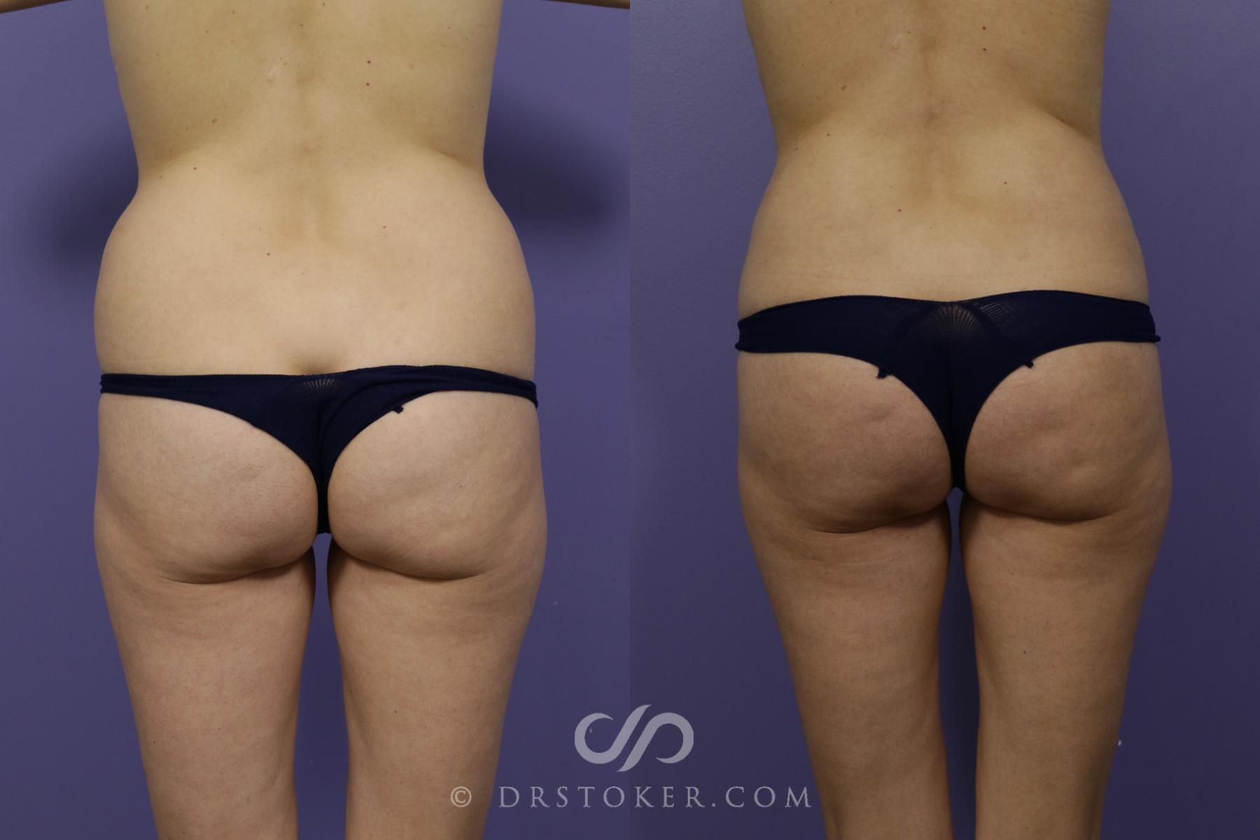 Before & After Liposuction Case 1556 View #1 View in Los Angeles, CA