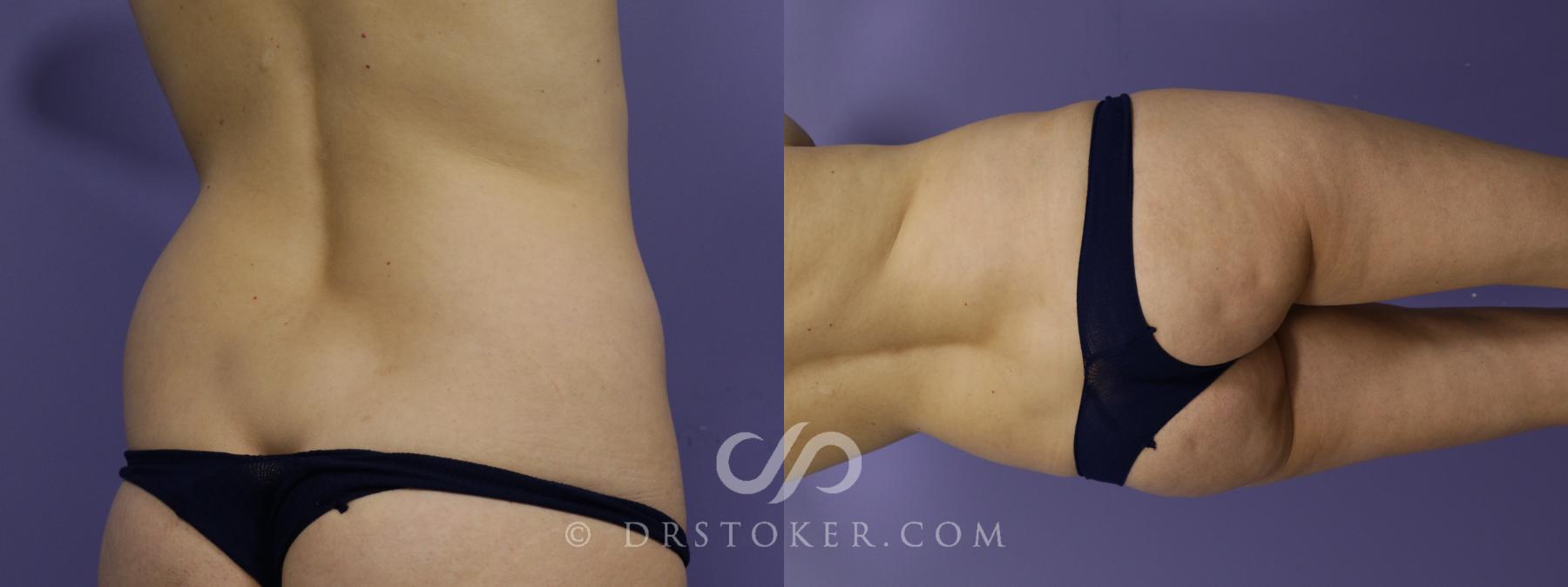 Before & After Liposuction Case 1556 View #2 View in Los Angeles, CA