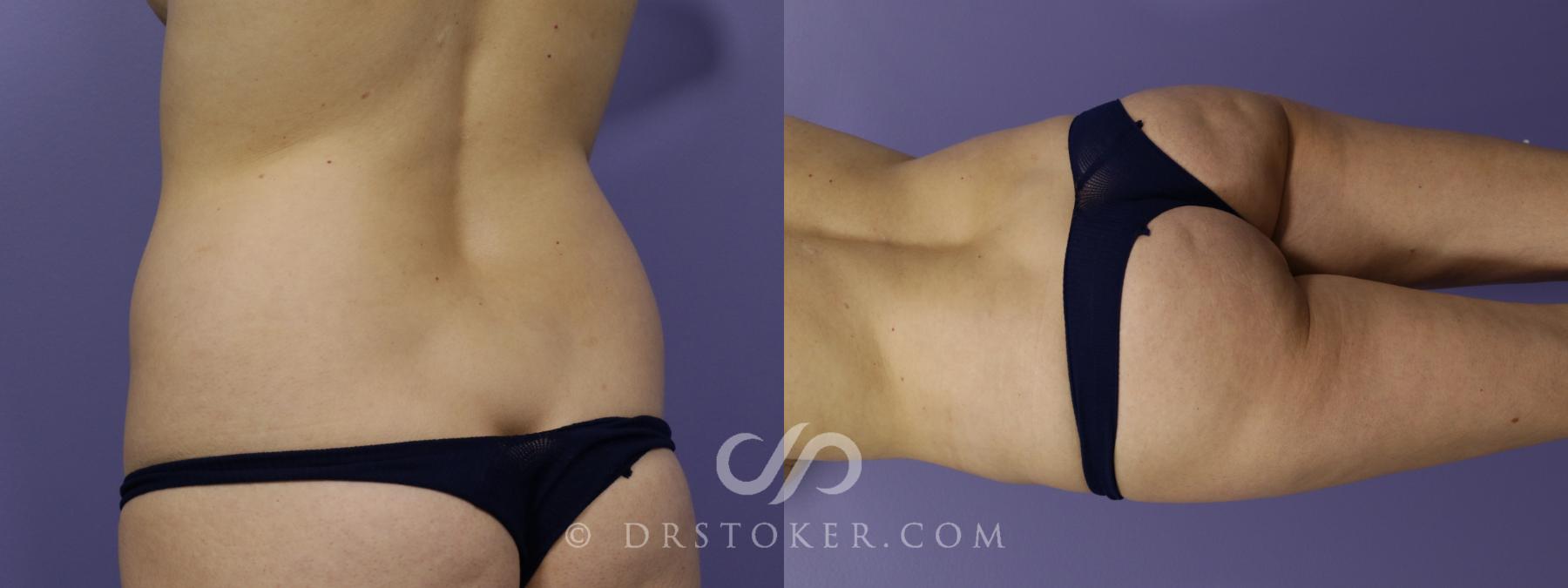 Before & After Liposuction Case 1556 View #3 View in Los Angeles, CA