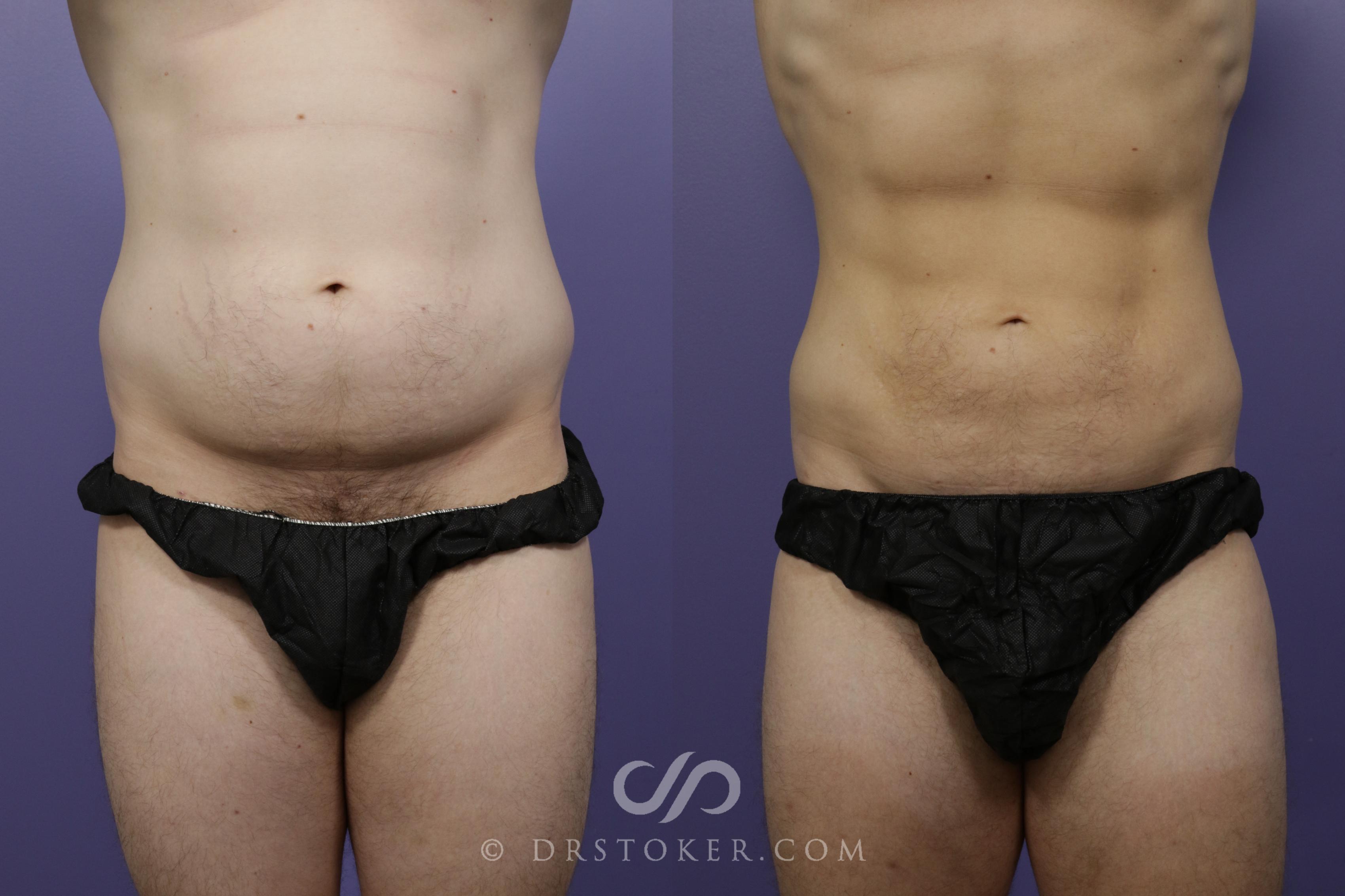 Liposuction - Abdominal Etching & Sculpting Before and After Photo Gallery, Los Angeles, CA