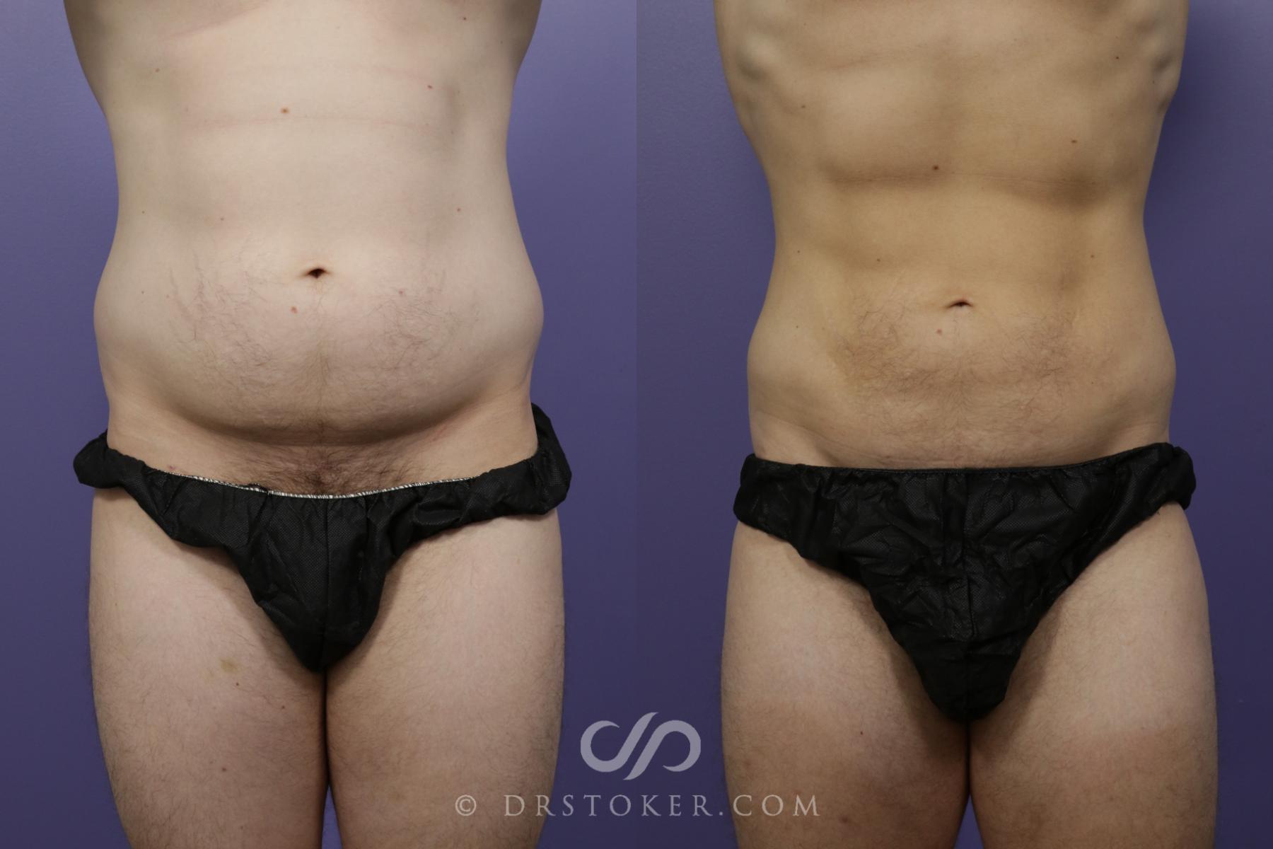 Before & After Liposuction Case 1559 View #1 View in Los Angeles, CA