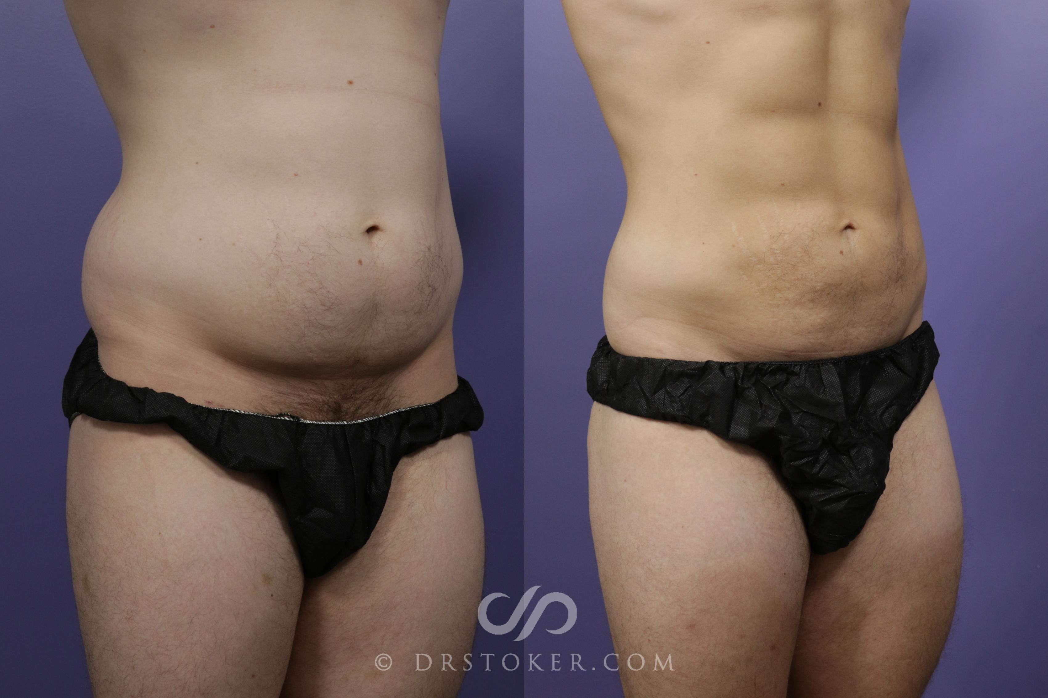 Before & After Liposuction - Abdominal Etching & Sculpting Case 1559 View #2 View in Los Angeles, CA