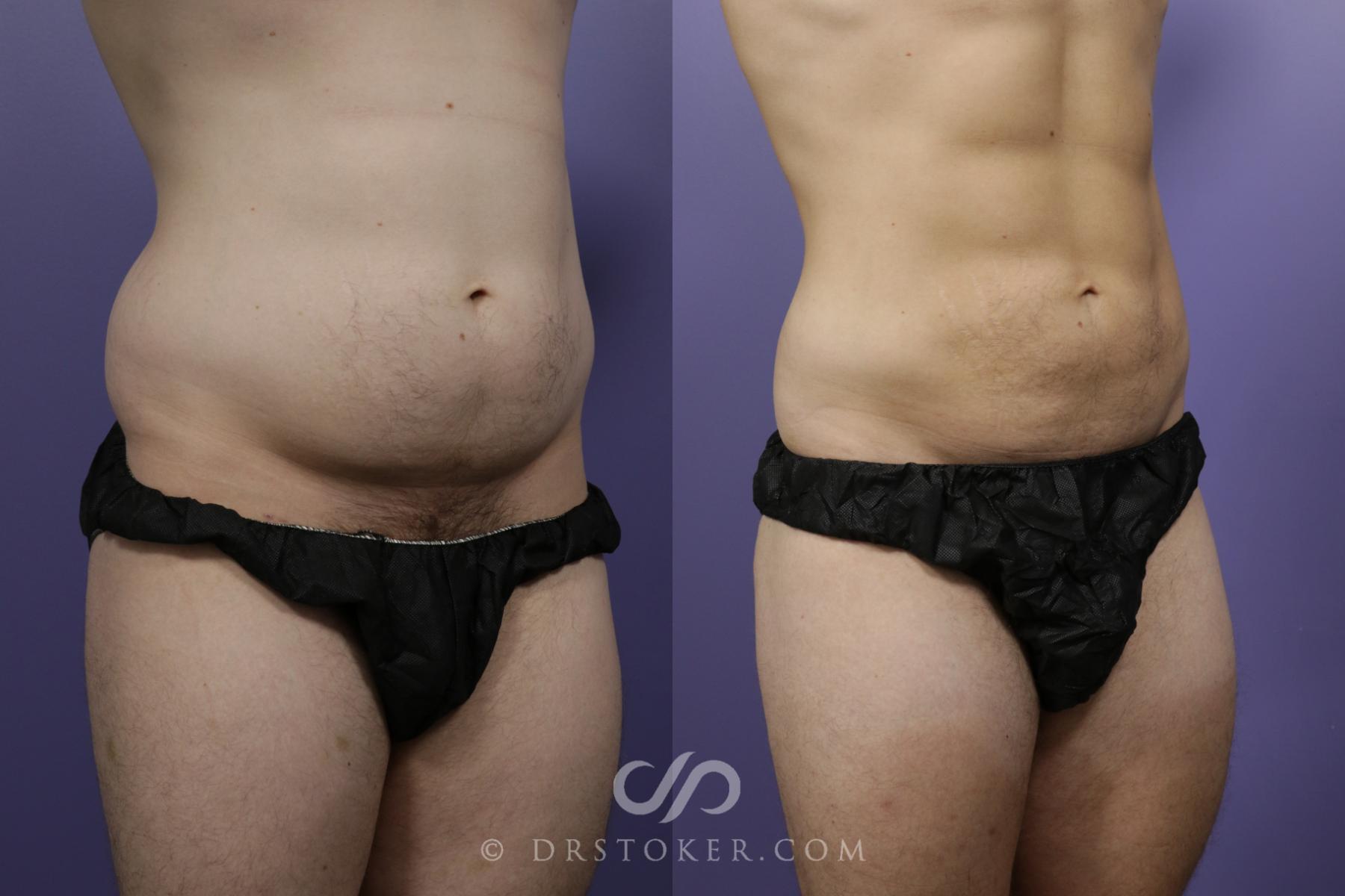 Before & After Liposuction for Men Case 1559 View #2 View in Los Angeles, CA