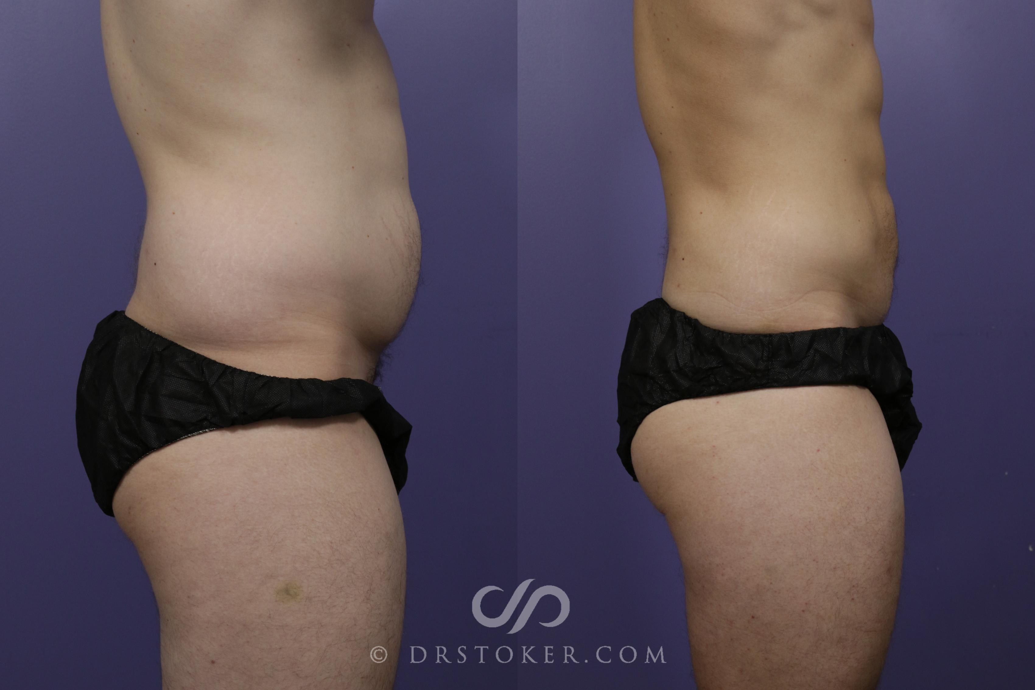 Before & After Liposuction - Abdominal Etching & Sculpting Case 1559 View #3 View in Los Angeles, CA