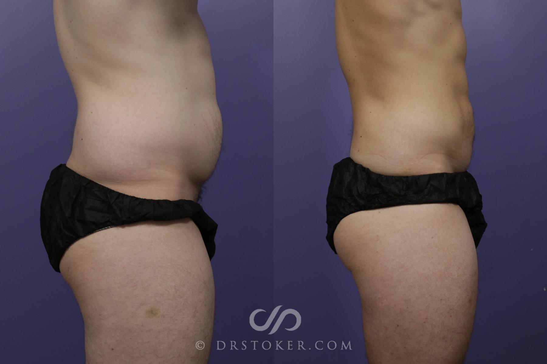 Before & After Abdominal Etching & Sculpting for Men Case 1559 View #3 View in Los Angeles, CA