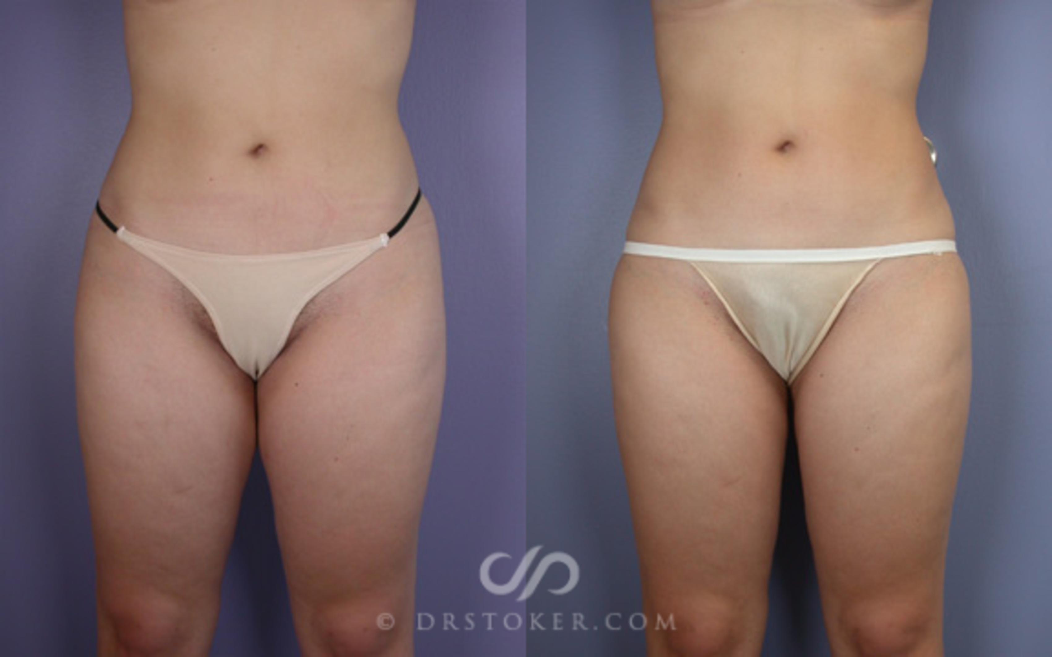 Before & After Liposuction Case 16 View #1 View in Los Angeles, CA