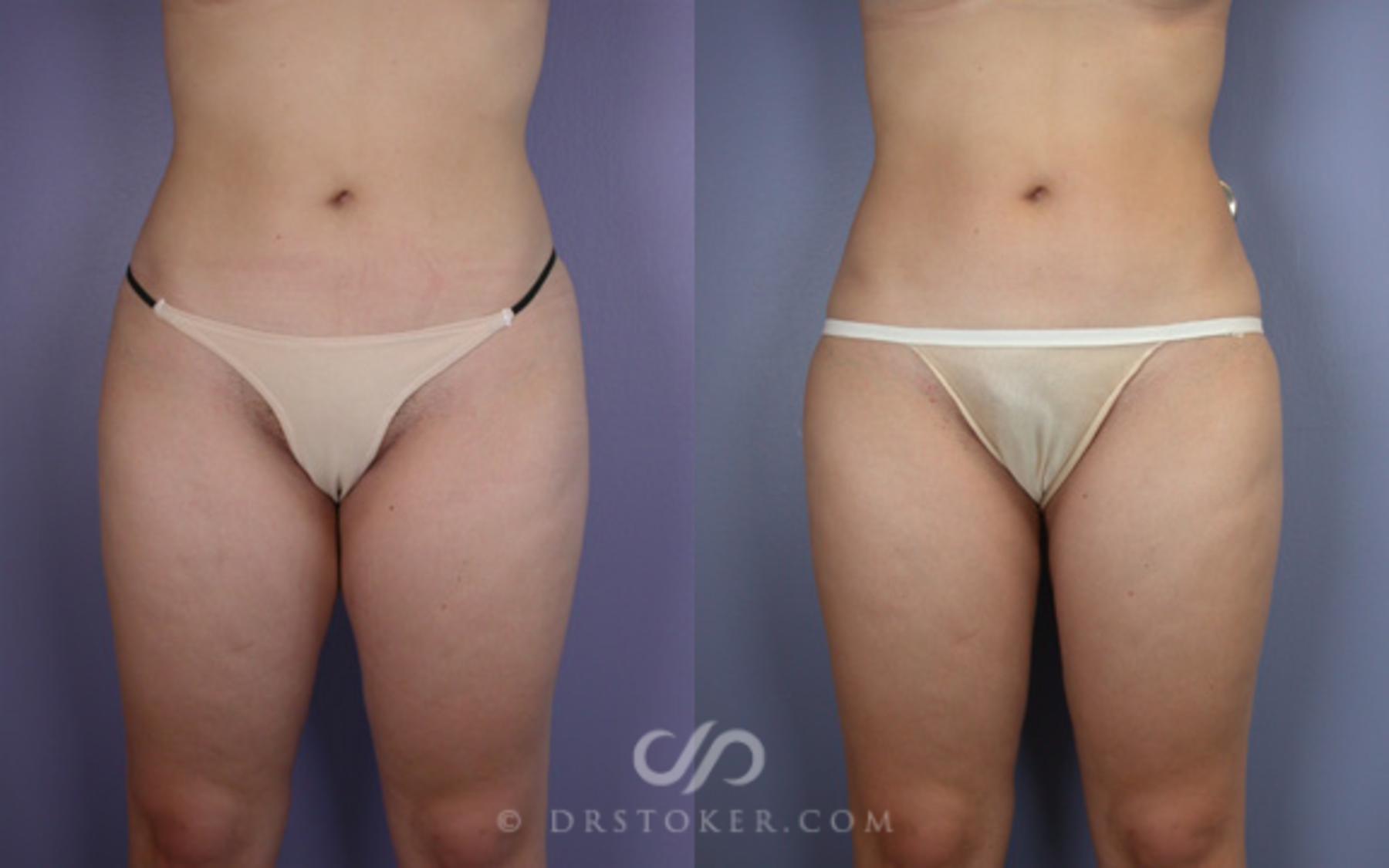 Before & After Liposuction Case 16 View #1 View in Los Angeles, CA