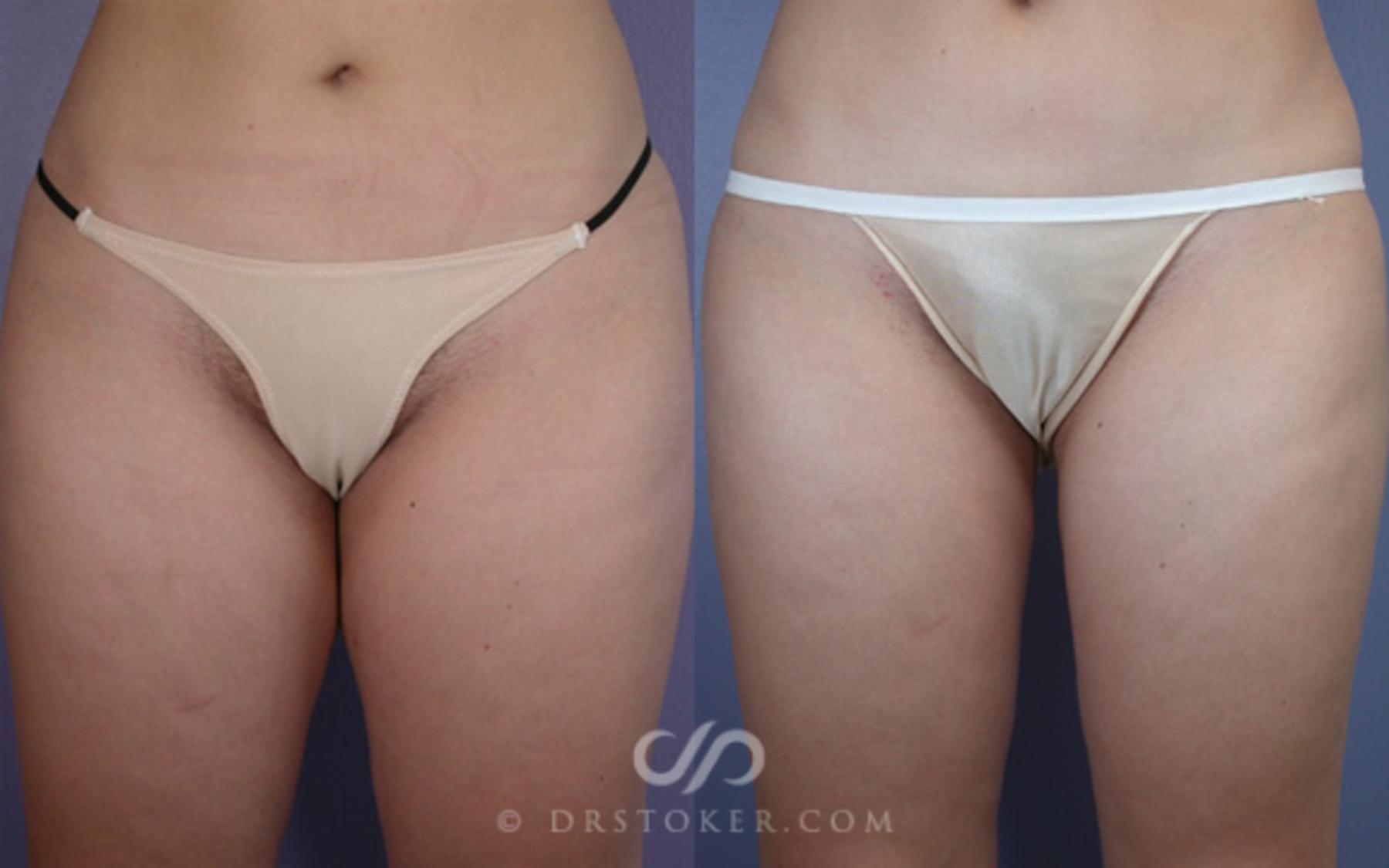 Liposuction Before and After Pictures Case 16 Los Angeles, CA Stoker Plastic Surgery picture