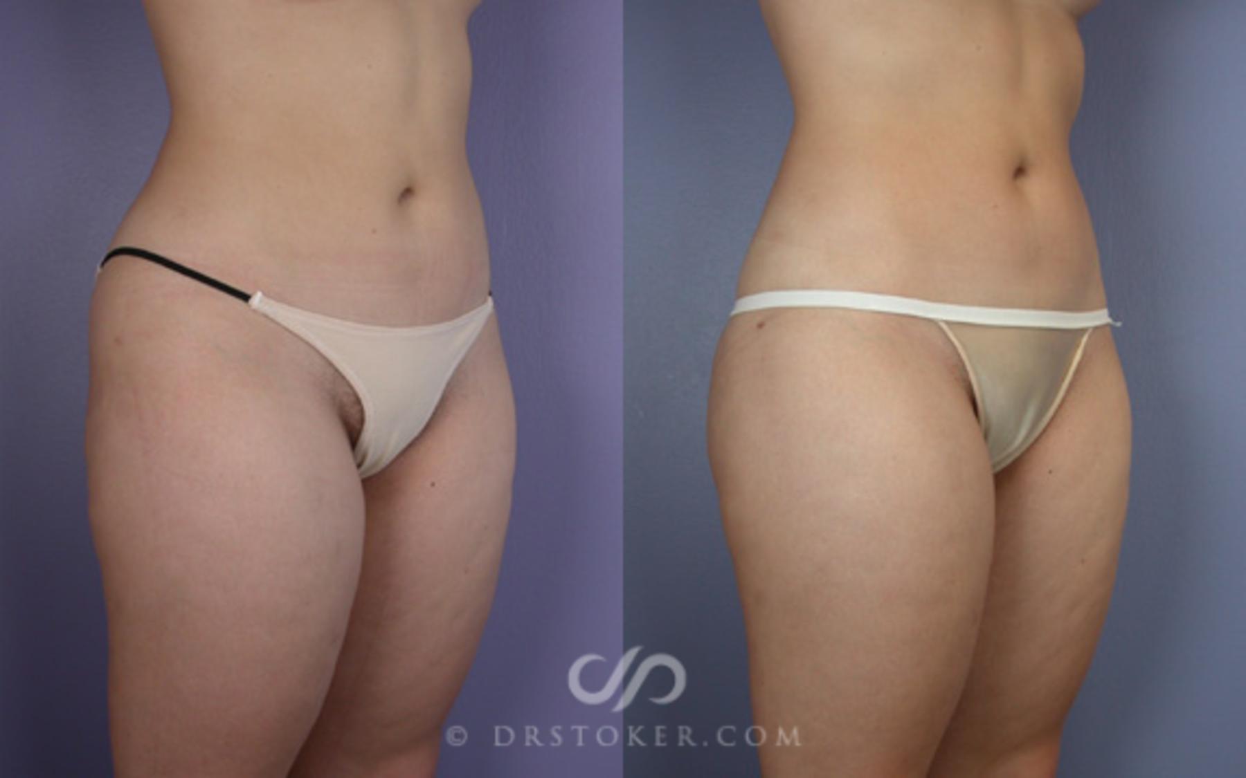 Before & After Liposuction Case 16 View #3 View in Los Angeles, CA