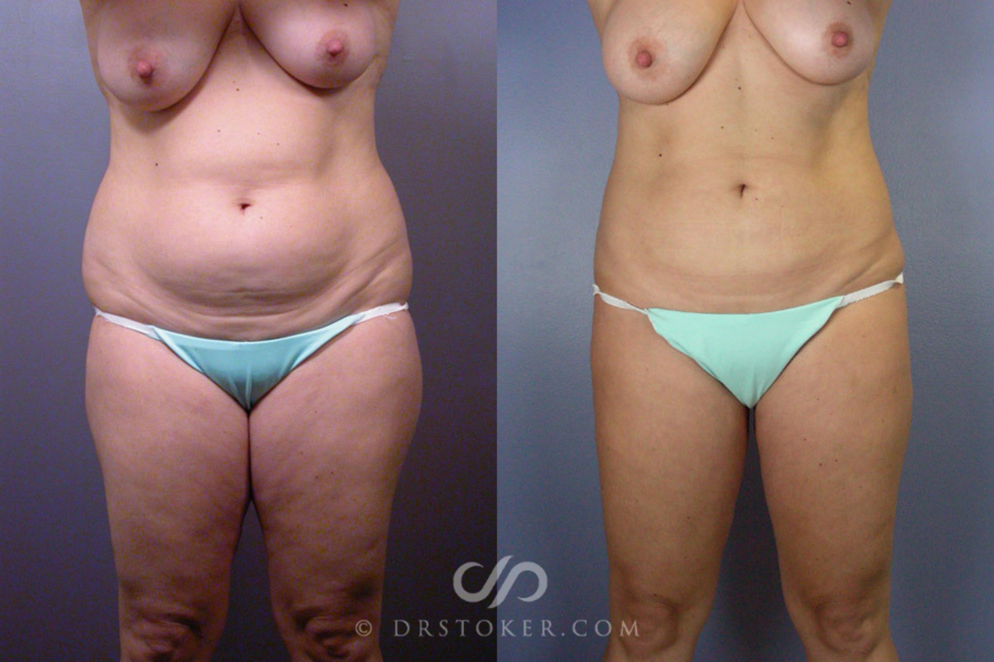 Before & After Liposuction Case 160 View #1 View in Los Angeles, CA