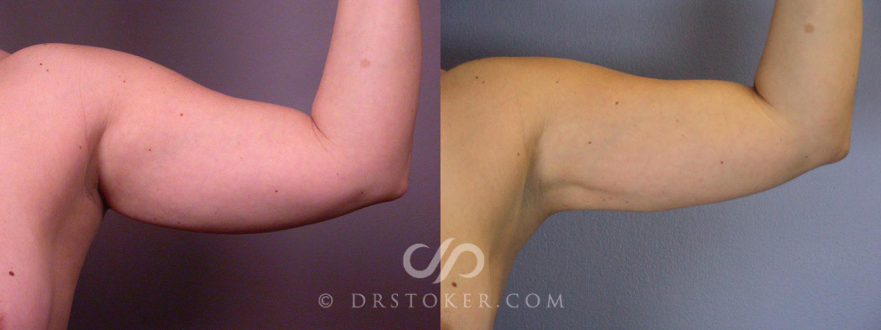 Before & After Liposuction Case 160 View #10 View in Los Angeles, CA