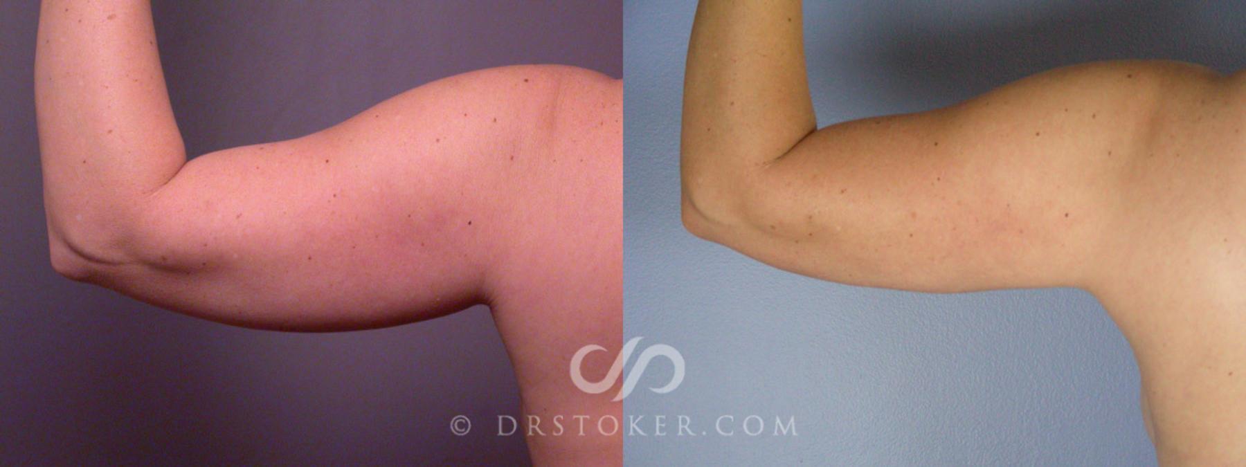 Before & After Liposuction Case 160 View #11 View in Los Angeles, CA